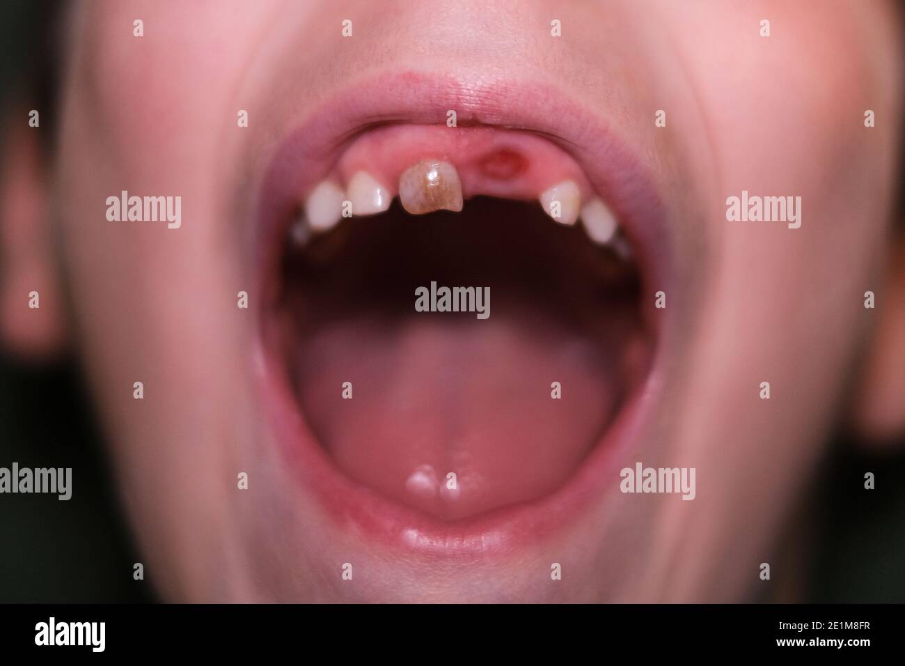 Bocca del bambino piccolo senza denti, salute dei bambini cura dei denti, odontoiatria Foto Stock