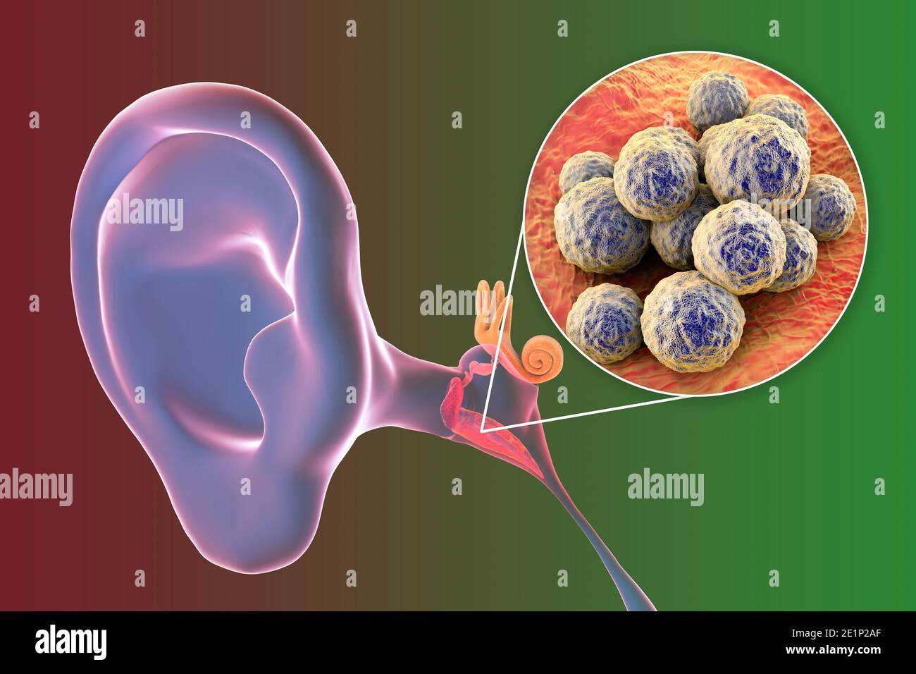 Otite media infezione dell'orecchio, illustrazione Foto Stock