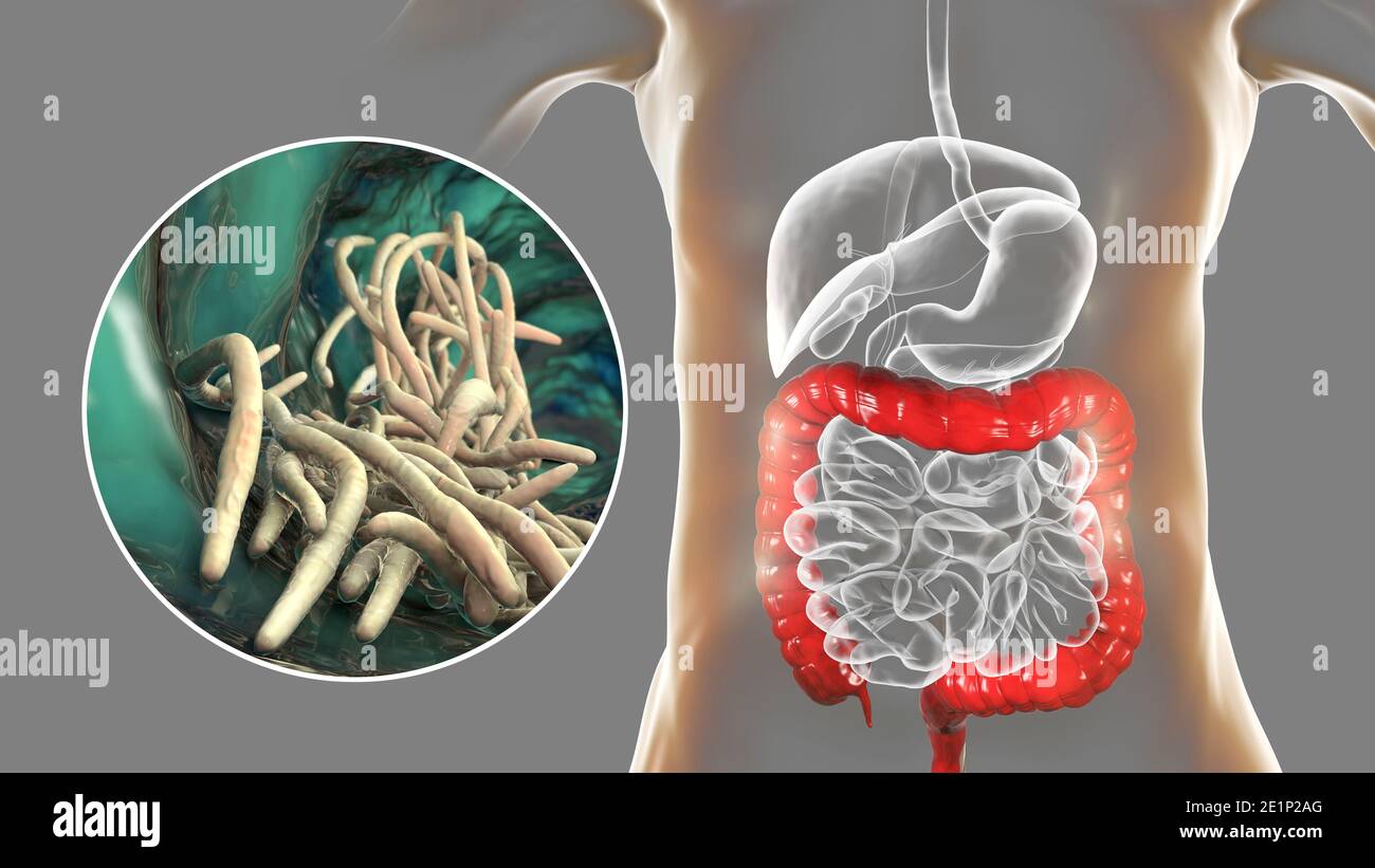 Vermi rotondi nell'intestino crasso umano, illustrazione Foto Stock