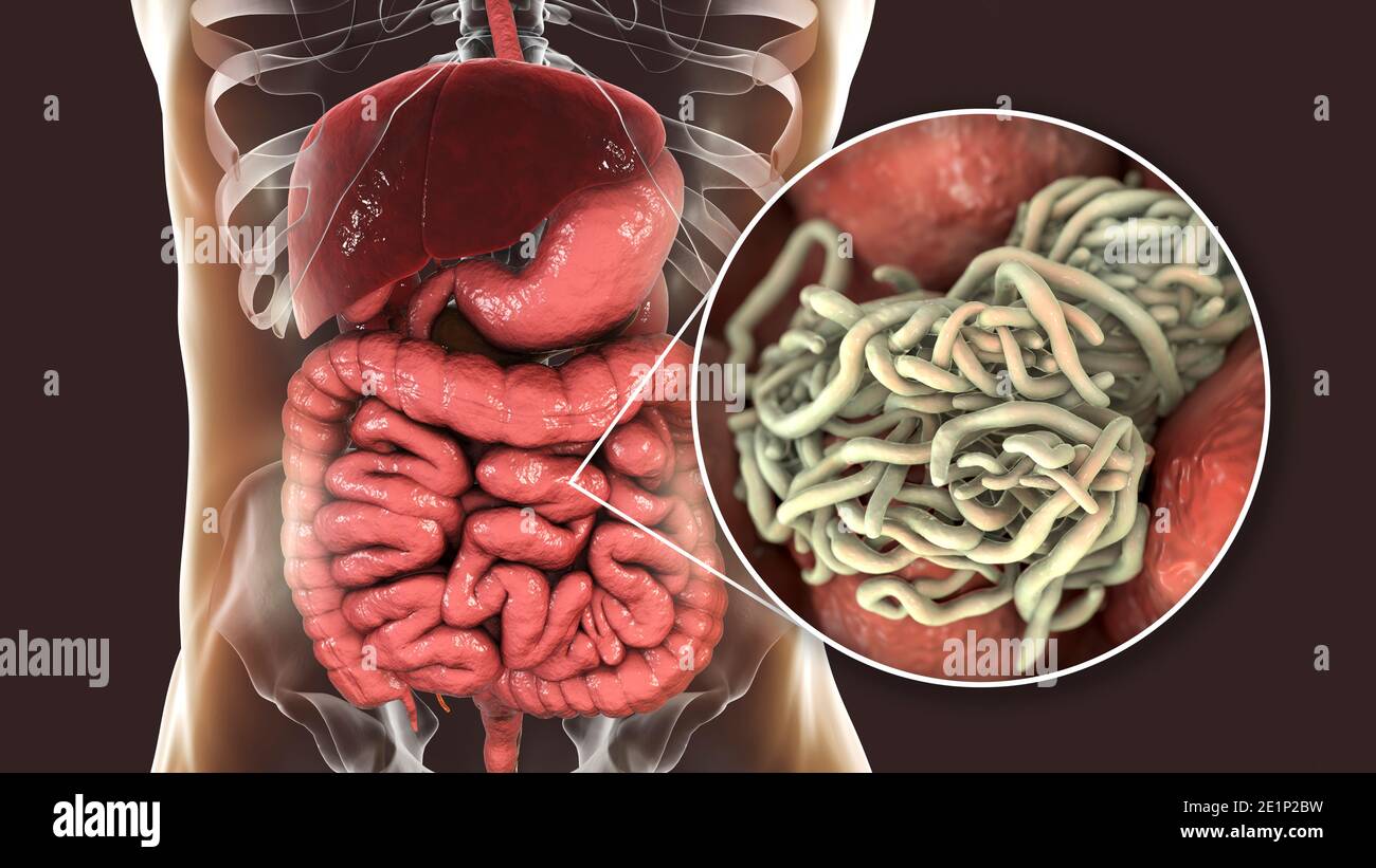 Vermi rotondi nell'intestino umano, illustrazione Foto Stock