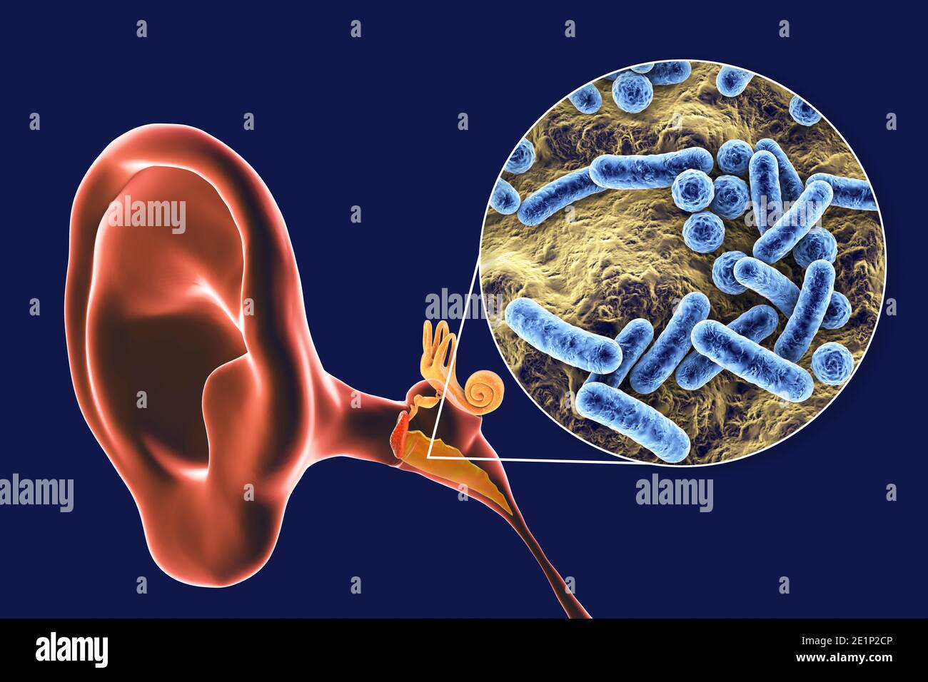 Otite media infezione dell'orecchio, illustrazione Foto Stock
