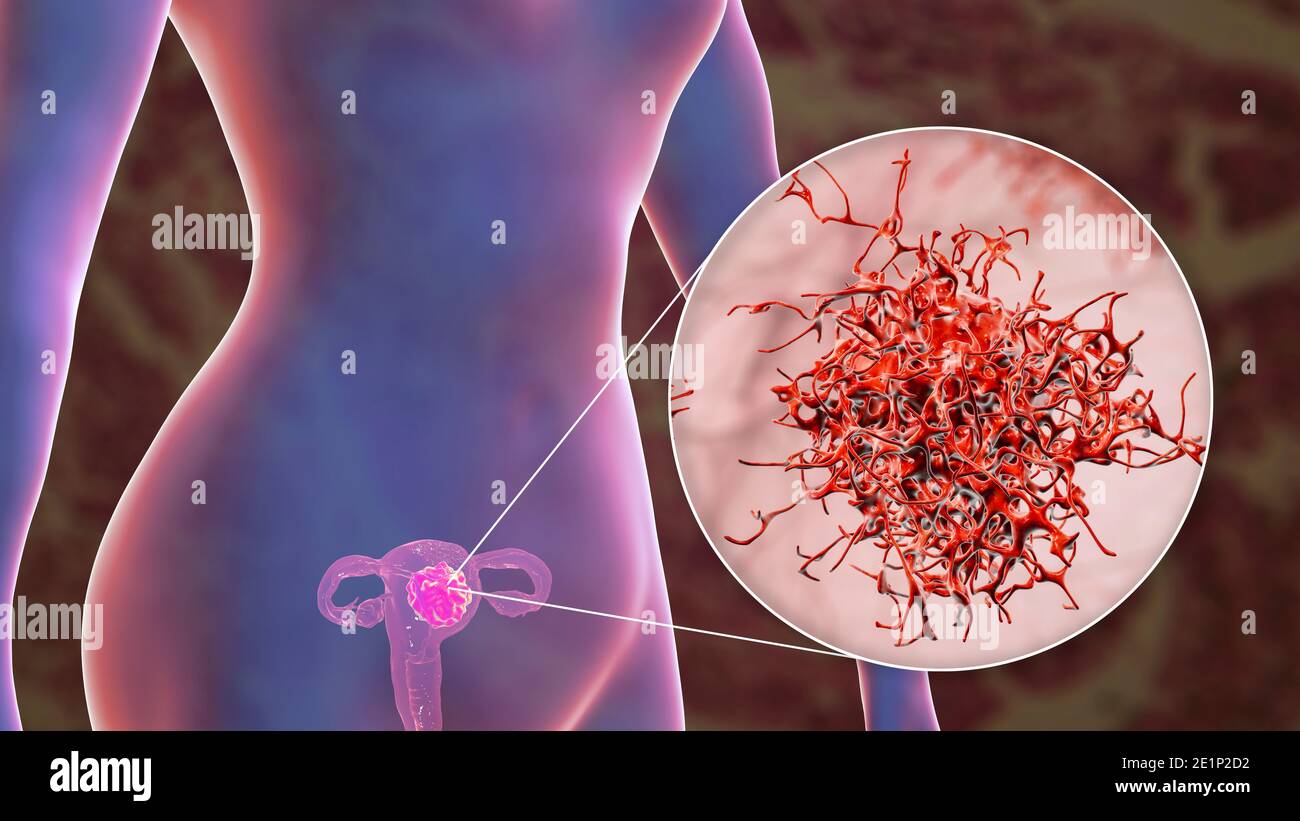 Cancro uterino, illustrazione Foto Stock