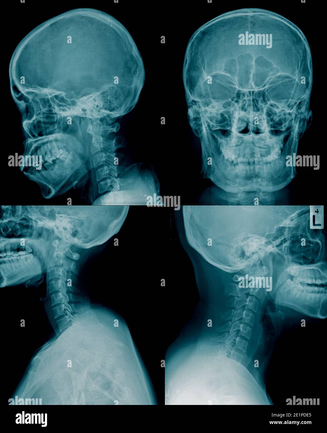 Cranio di raccolta di immagini a raggi x in tonalità blu Foto Stock