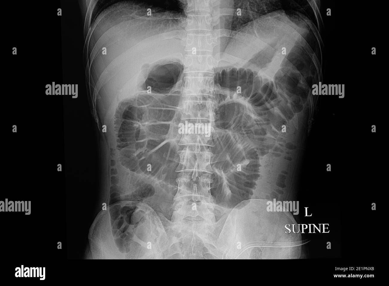 Una pellicola addominale a raggi X supina di un paziente di sesso maschile con ostruzione meccanica intestinale. Foto Stock