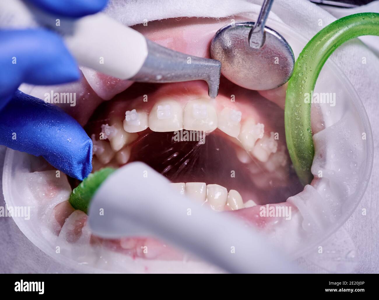 Fotografia macro. Processo di pulizia nella bocca del paziente con  riavvolgitore della guancia e staffe sui denti. Pulizia dei denti con getto  d'acqua ed espulsore di saliva. Concetto di igiene dentale professionale