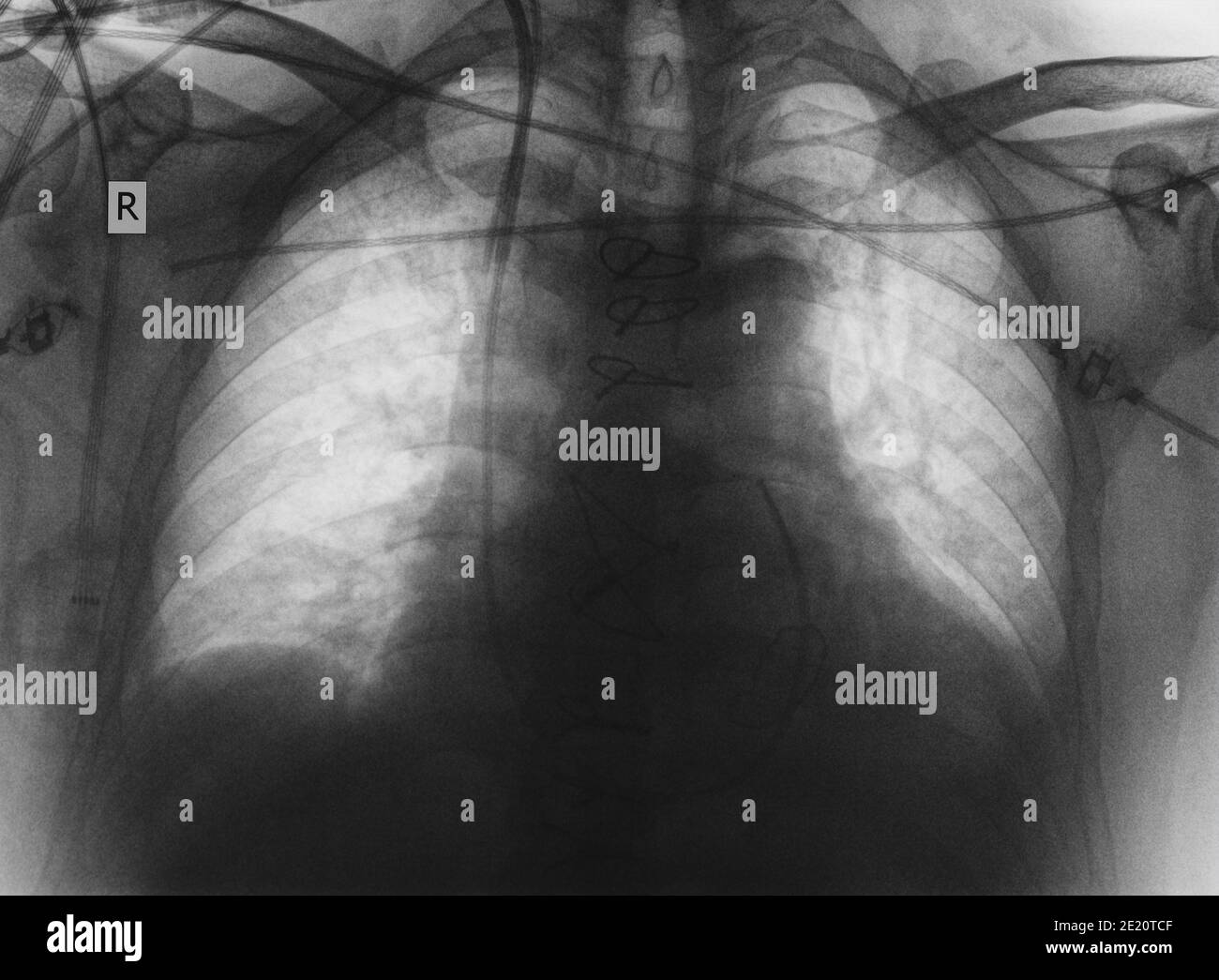 Immagine radiografica di polmoni e cuore. Foto Stock