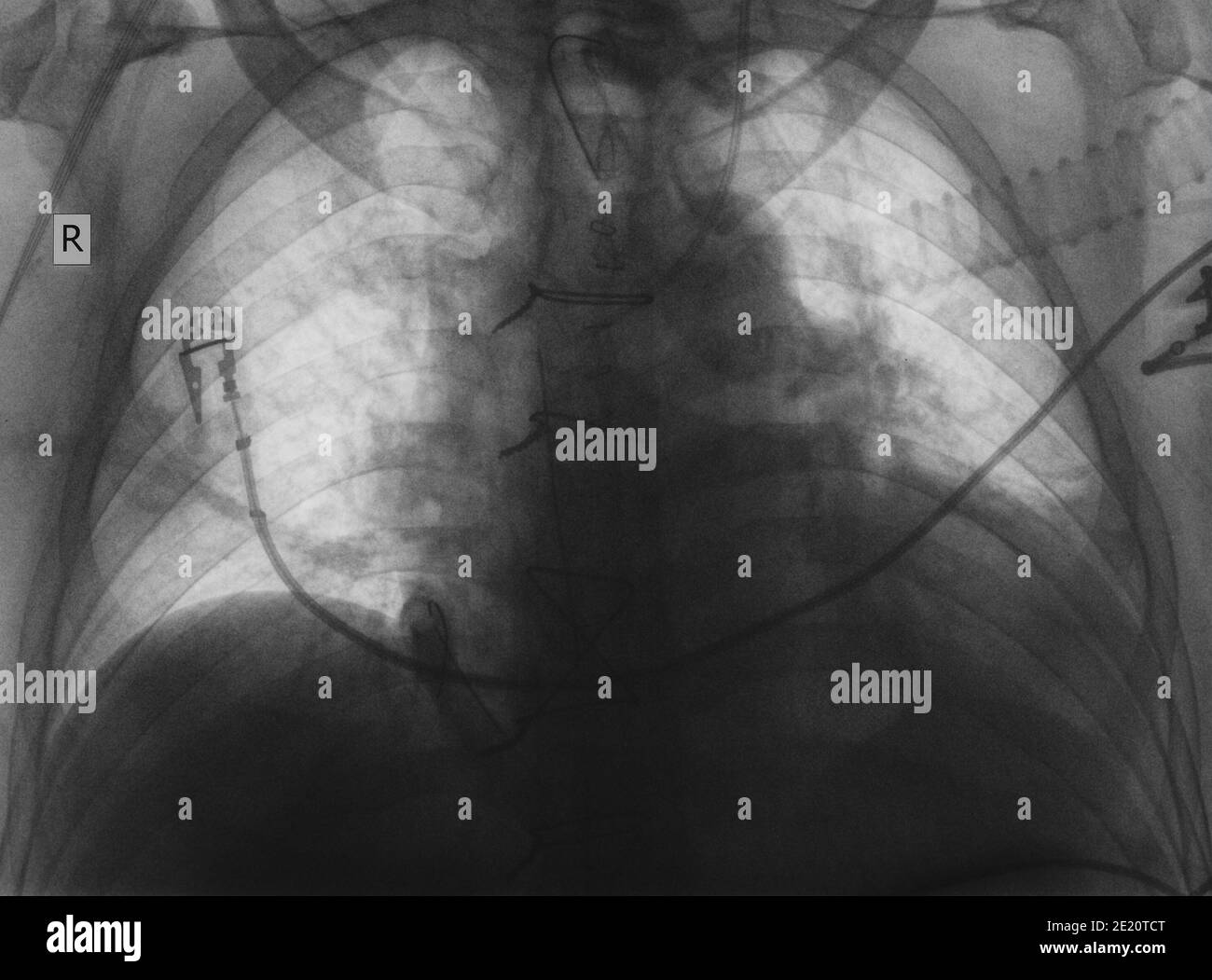 Esame radiologico del paziente dopo intervento chirurgico cardiaco. Foto Stock