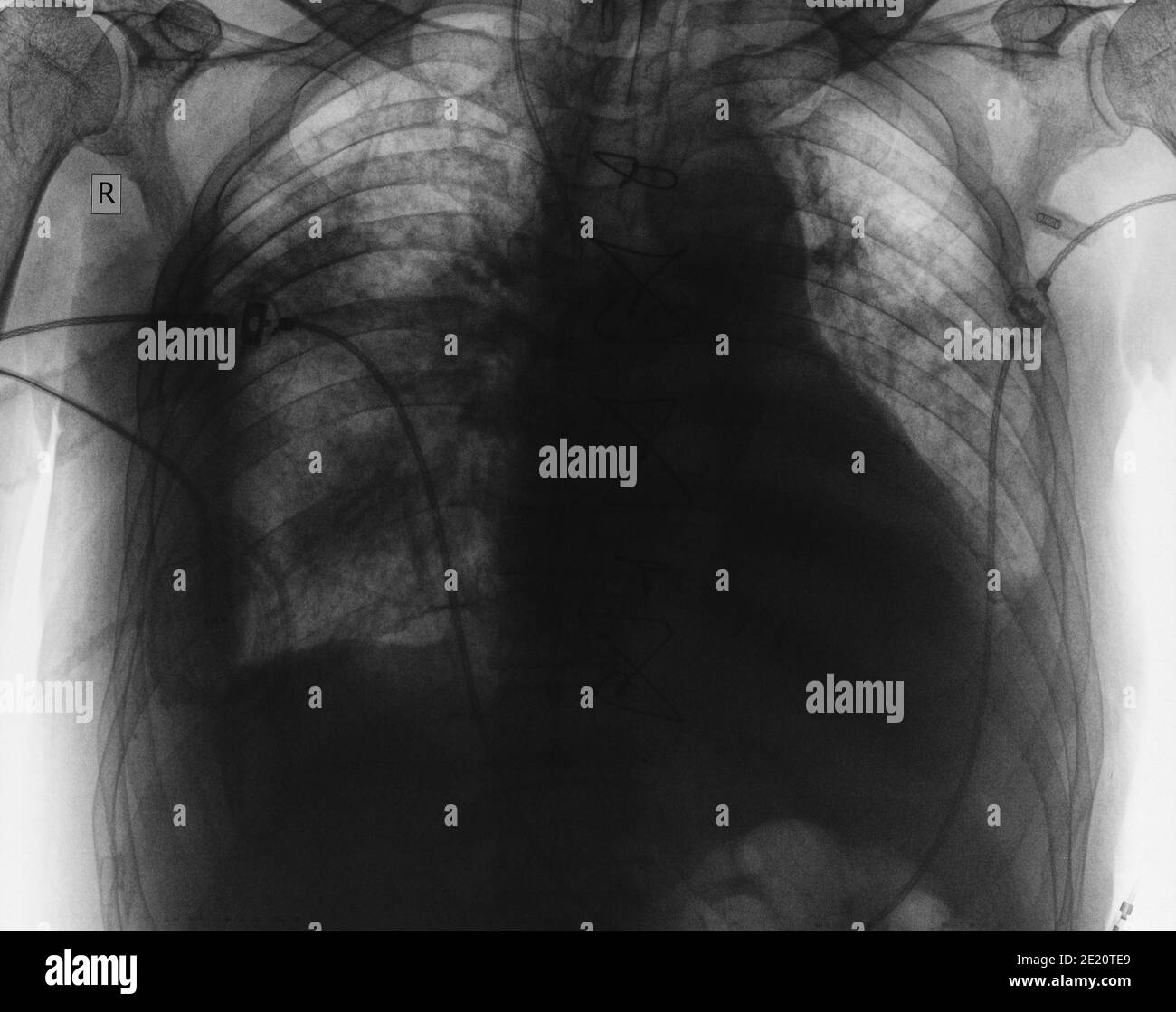 Immagine radiografica degli organi toracici del paziente. Foto Stock