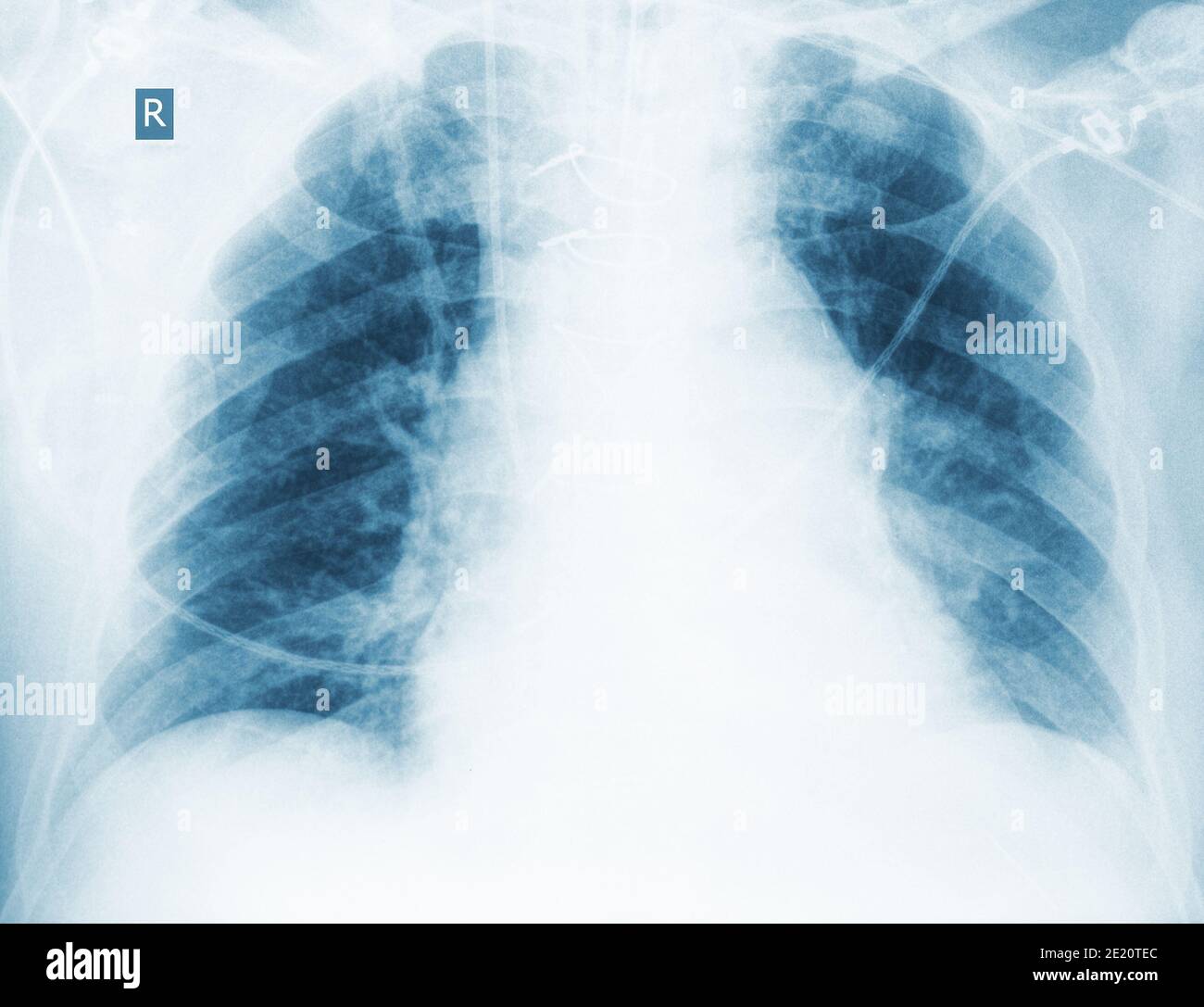 Controllo radiologico della polmonite ipostatica. Foto Stock Controllo radiologico della polmonite ipostatica. Foto Stock