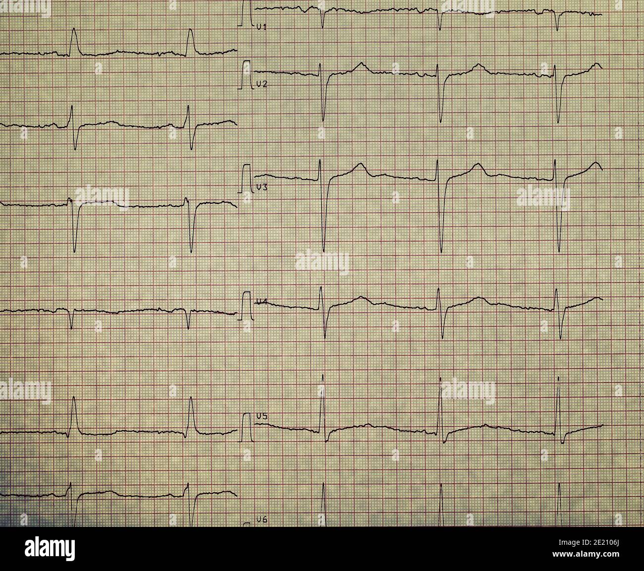 ECG sulla carta per il plottaggio. Foto Stock