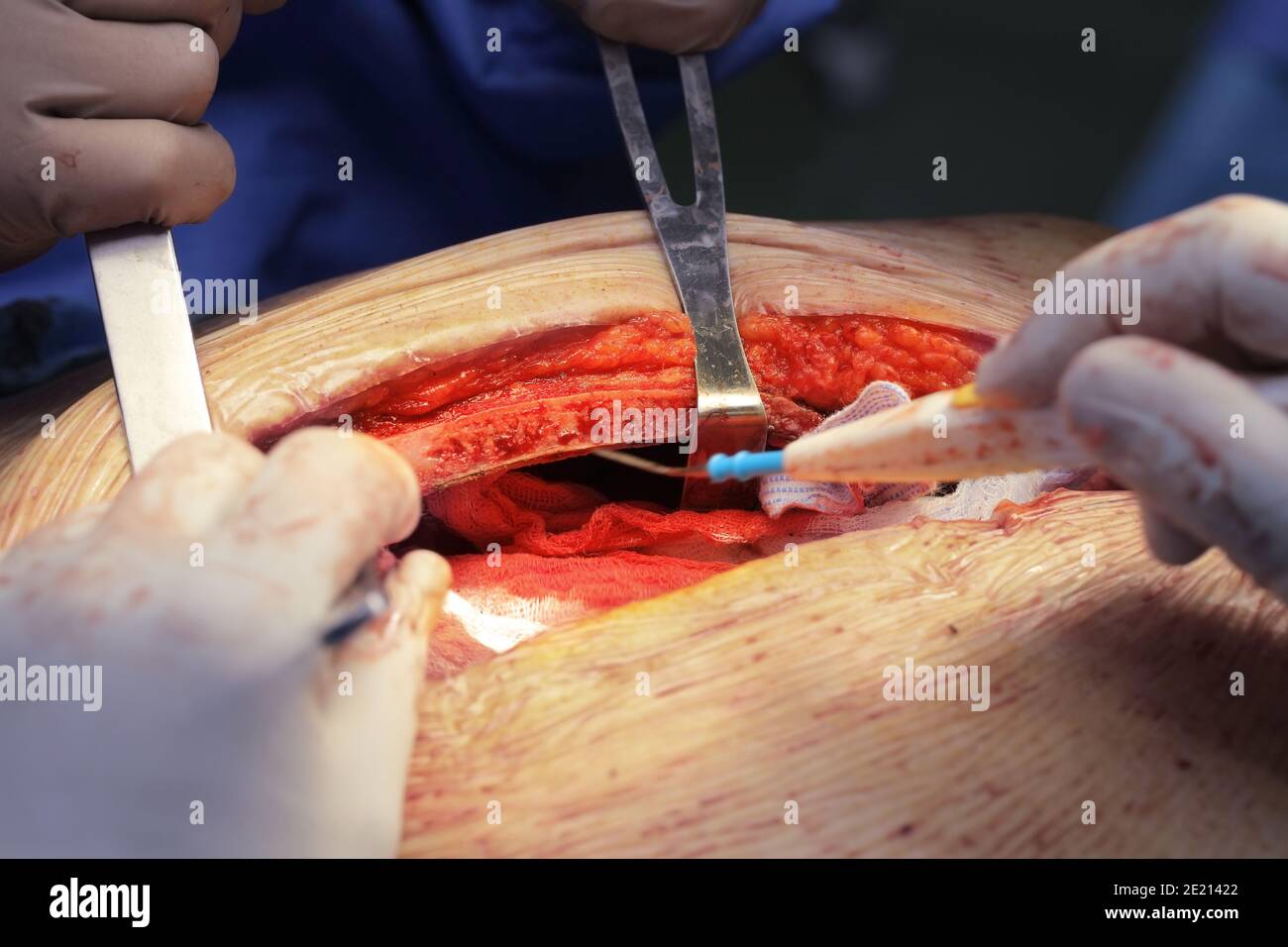 Chirurgia toracica nel processo. Foto Stock