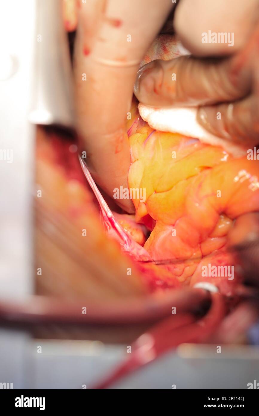 Intervento chirurgico in primo piano sul lavoro. Foto Stock