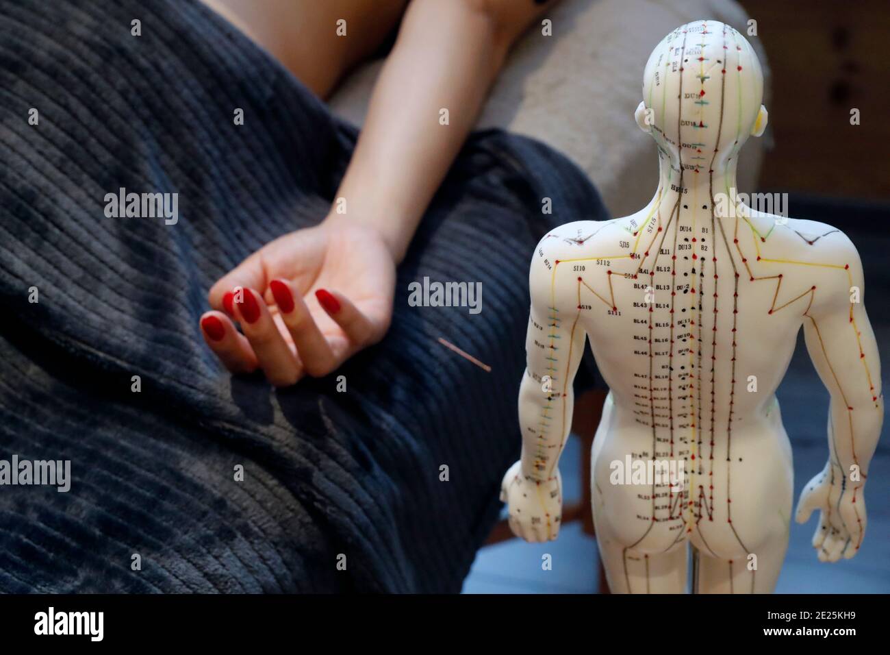 Tradizionale medecina cinese. Un modello maschile con punti di agopuntura marcati. Donna che ricava l'ago per agopuntura. Francia. Foto Stock