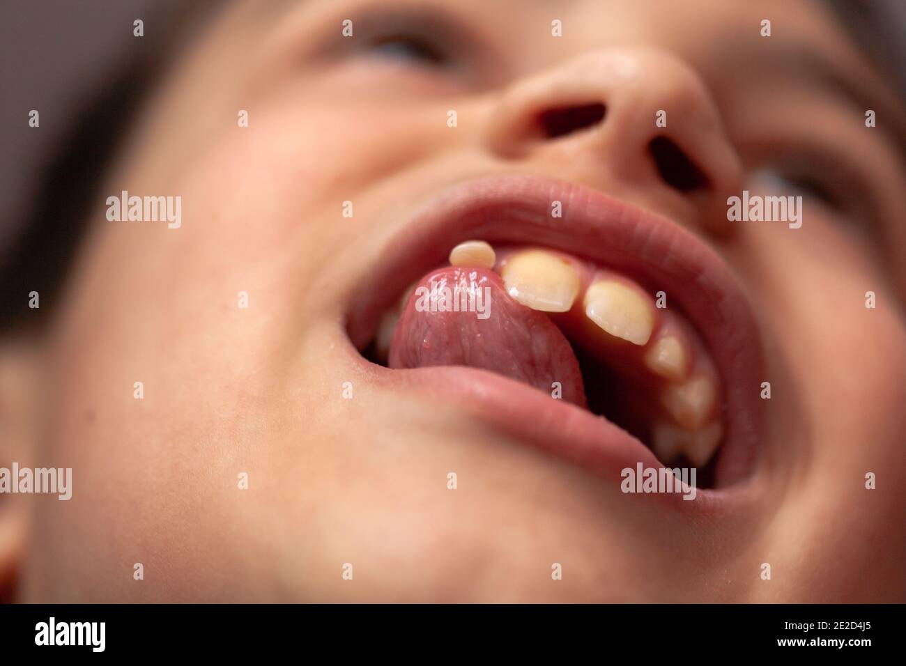 perdita di un dente del bambino in un bambino di otto anni, all'ultima fase Foto Stock