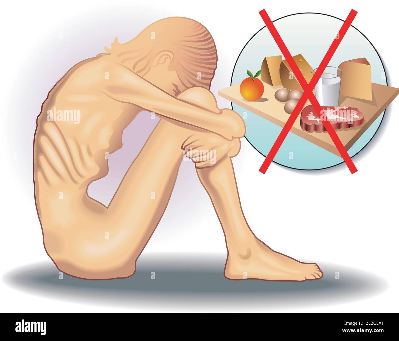 Illustrazione medica simbolica del disturbo alimentare chiamato anoressia Illustrazione Vettoriale