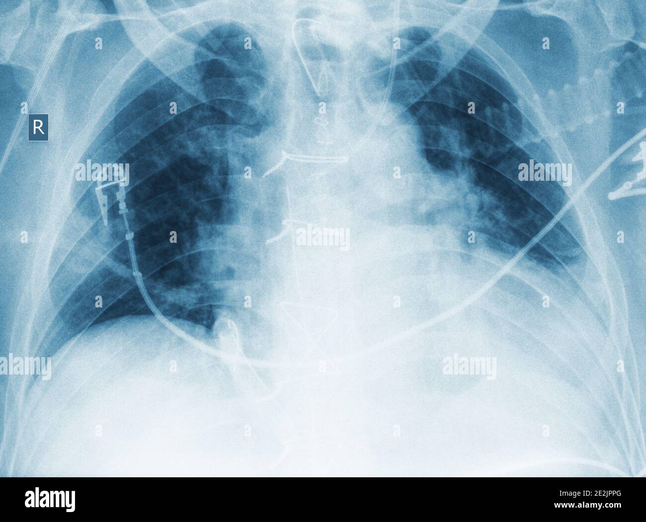 Immagine X-ry del paziente con polmonite. Foto Stock