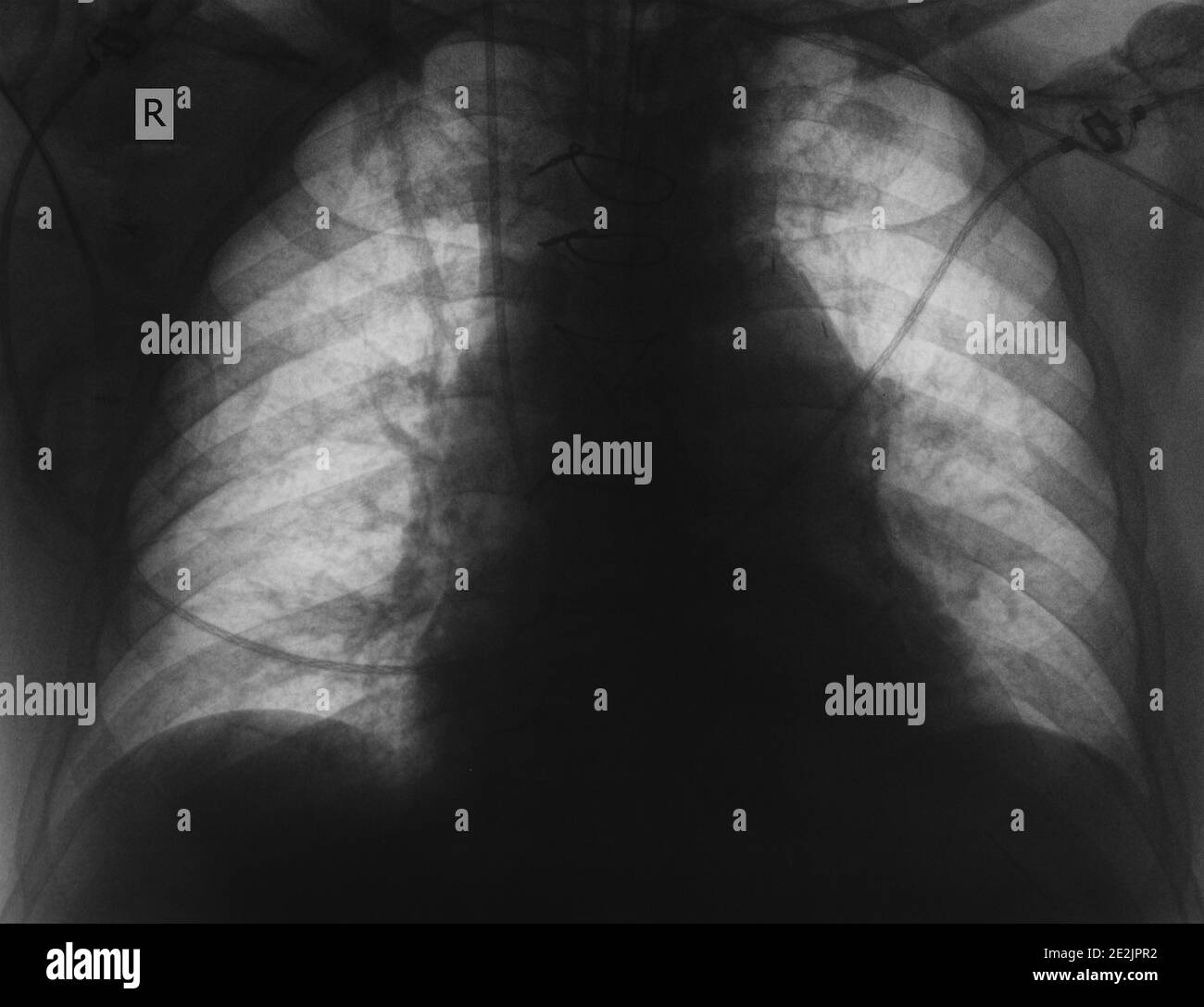 R-controllo del paziente con malattia polmonare. Foto Stock