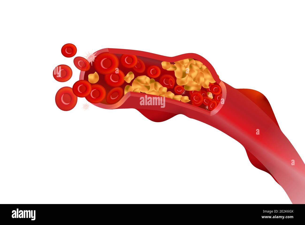 Arterie non sane con eritrociti rossi, illustrazione concetto di colesterolo alto isolato su bianco Illustrazione Vettoriale