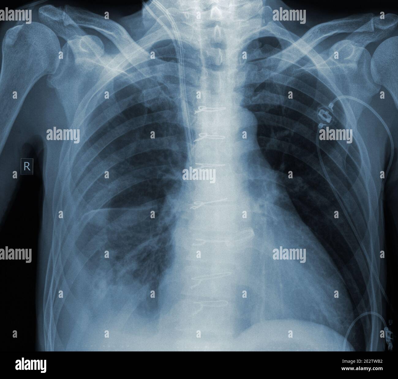 Immagine Roentgen del paziente nel reparto di chirurgia. Foto Stock