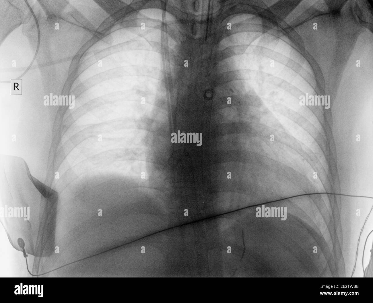 Immagine Roentgen del paziente in terapia intensiva. Foto Stock