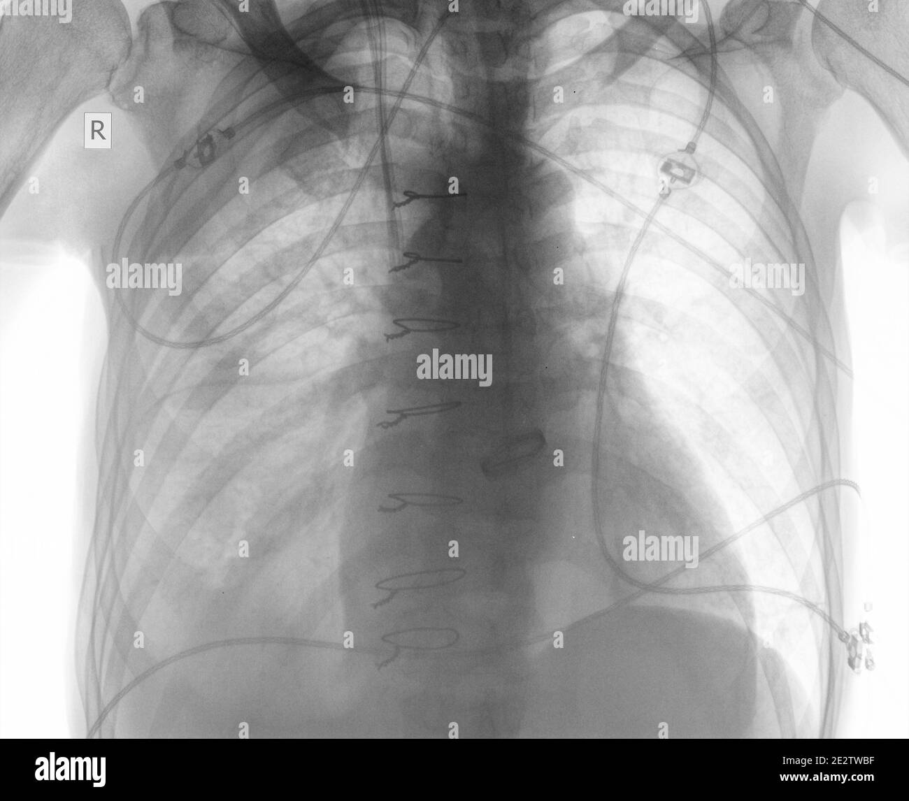 R-controllo del paziente dopo chirurgia cardiaca. Foto Stock