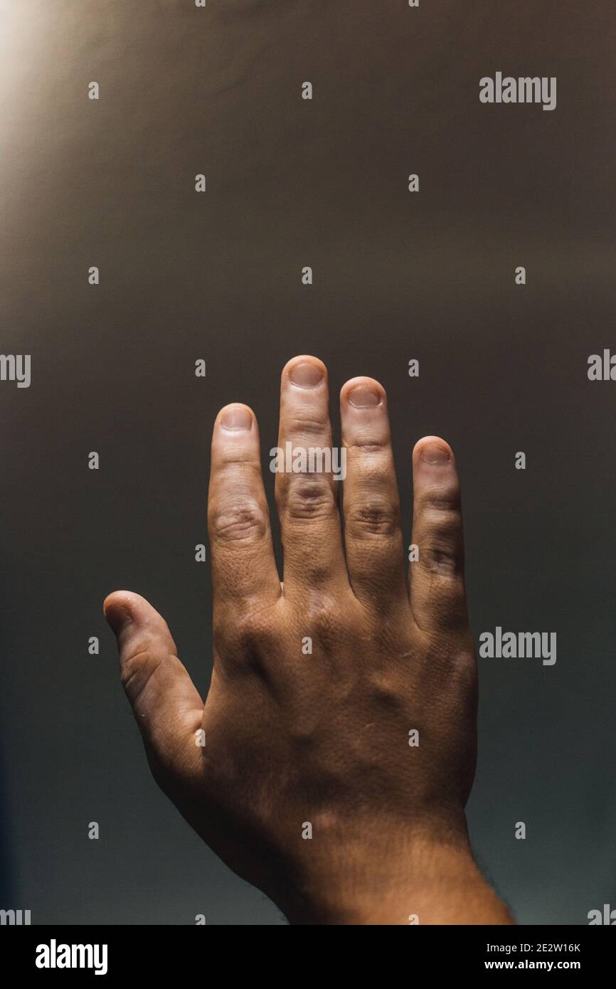 Vitiligo sulla mano su uno sfondo Foto Stock