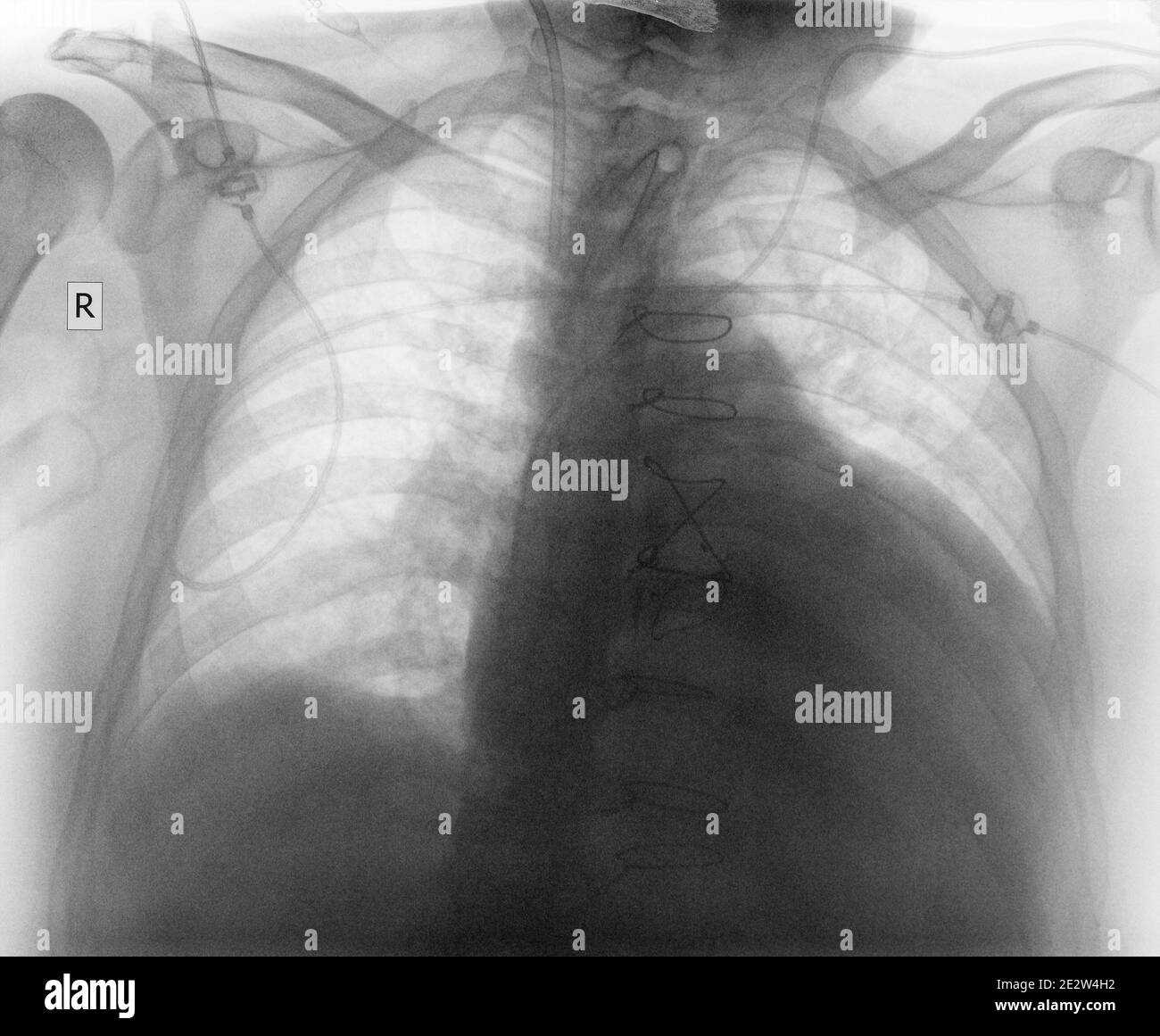 Immagine radiografica del torace dopo un intervento cardiaco. Foto Stock