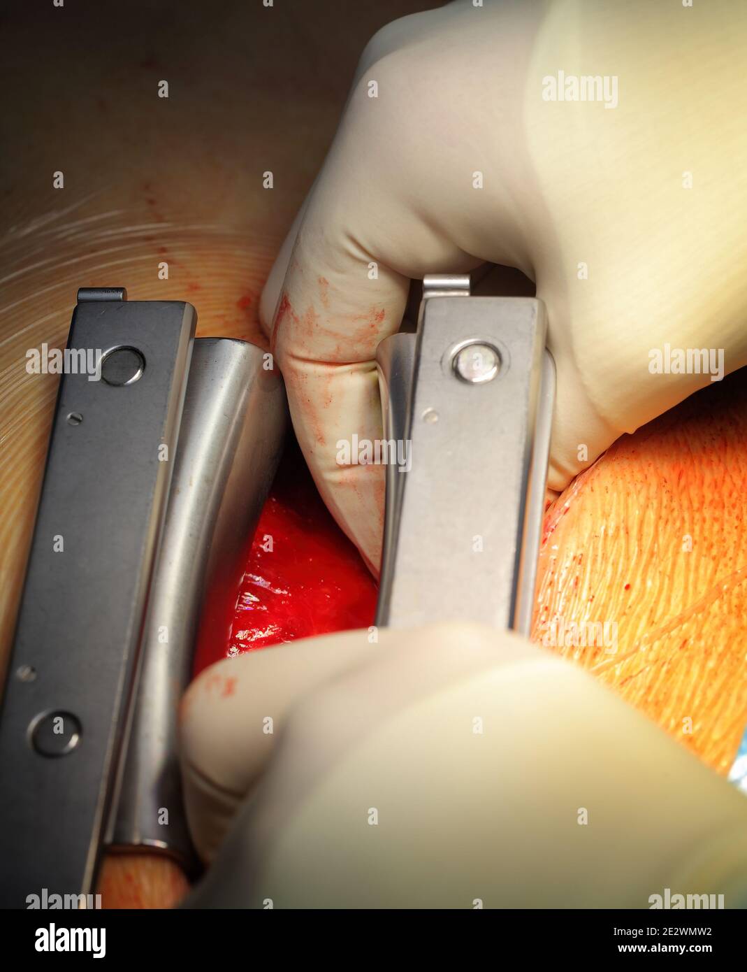 Utilizzo di utensili in acciaio durante l'intervento chirurgico. Foto Stock