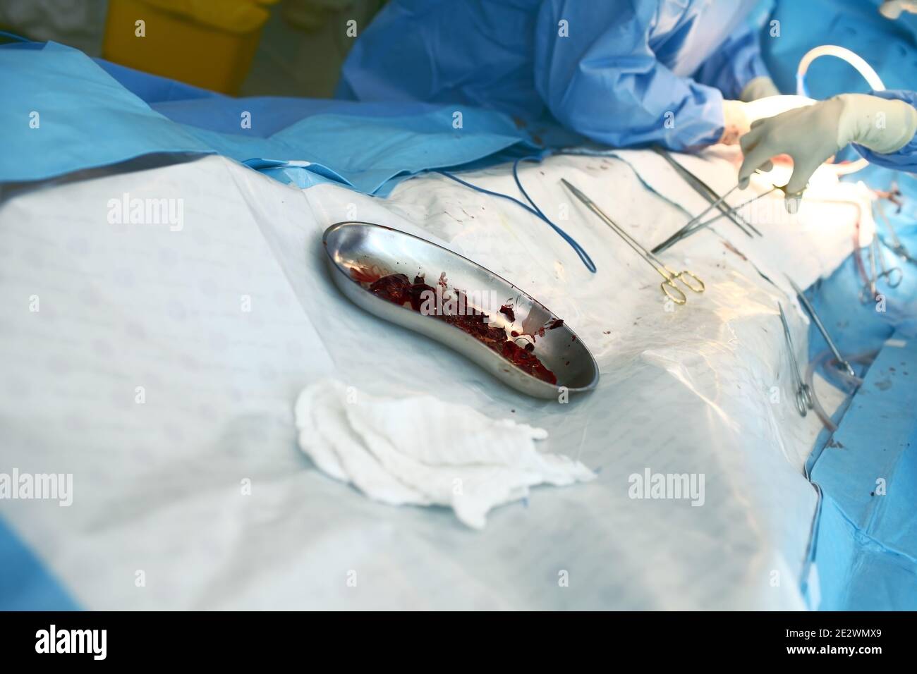 Coaguli di sangue eliminati dai vasi durante l'intervento chirurgico. Foto Stock