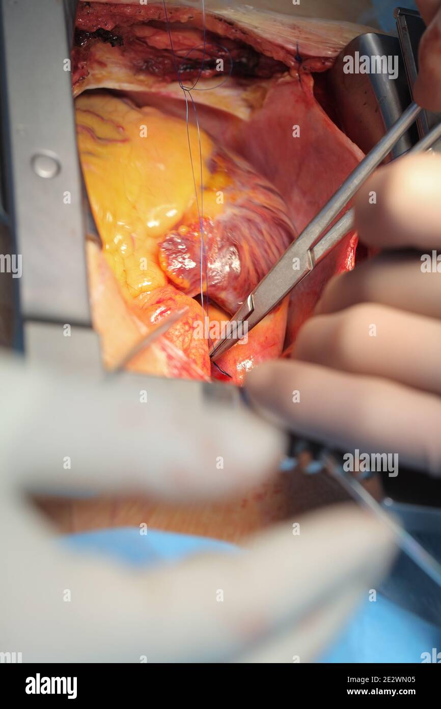 Suturazione del cuore durante il processo chirurgico. Foto Stock