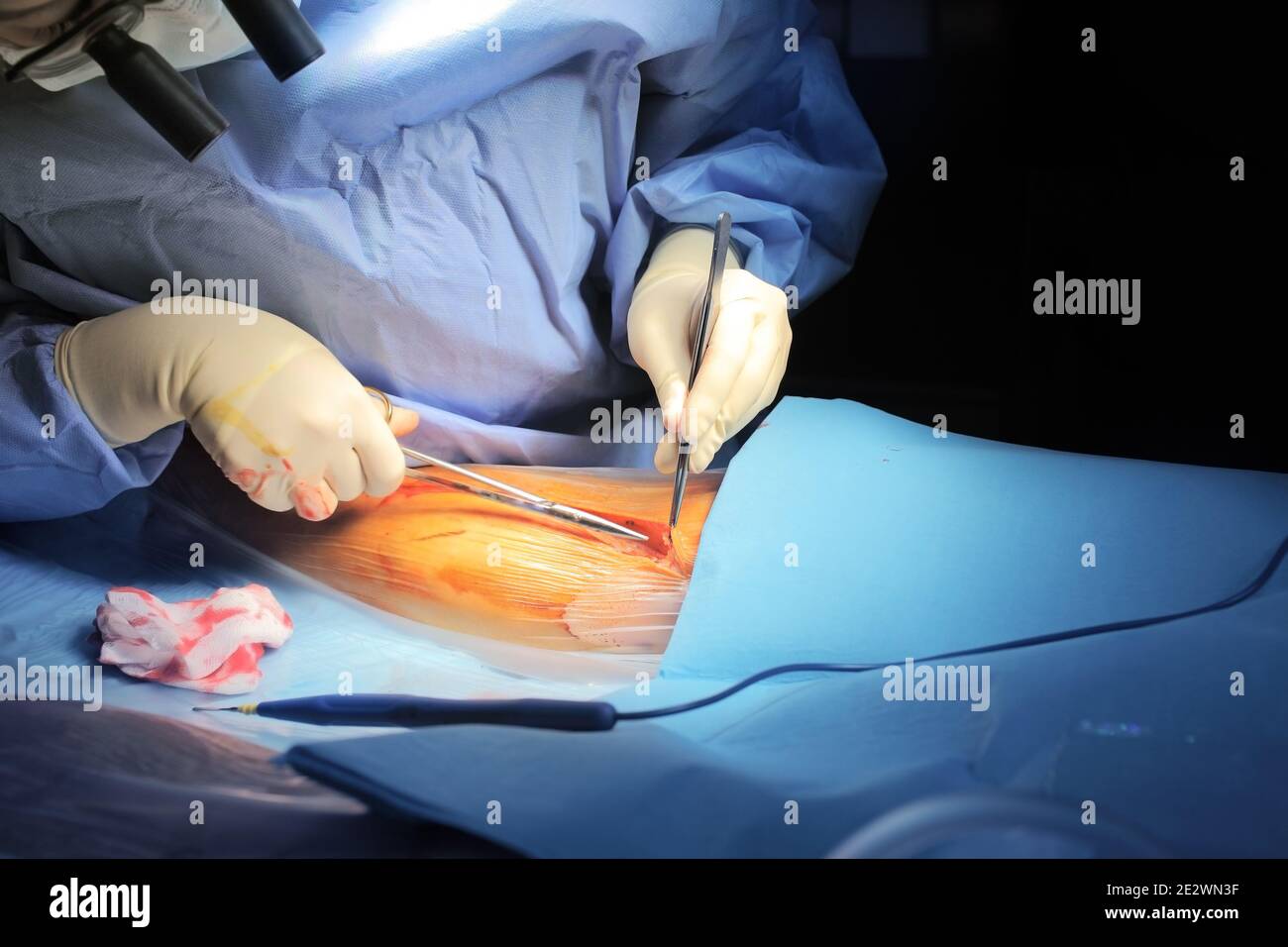 Il chirurgo taglia la pelle del paziente durante la procedura. Foto Stock