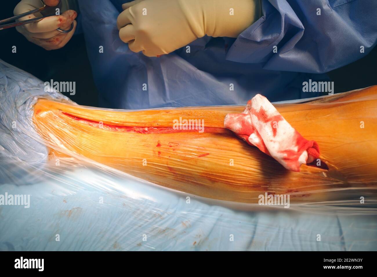 Insecazione cutanea durante la procedura chirurgica. Foto Stock