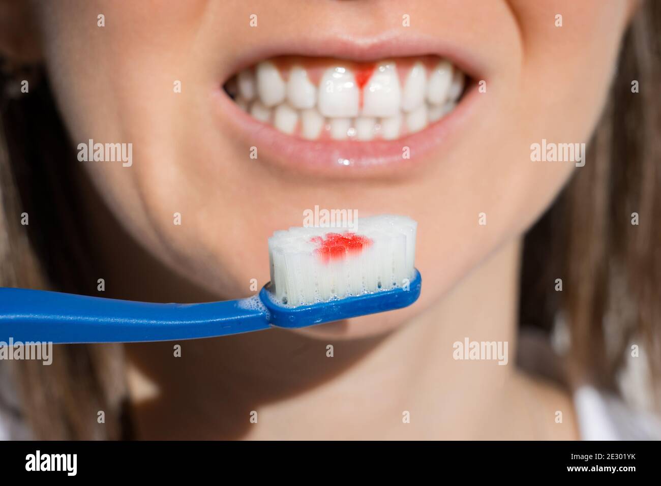 Bocca della donna con gengive sanguinanti durante la spazzolatura dei denti. Avitaminosi, gengivite Foto Stock