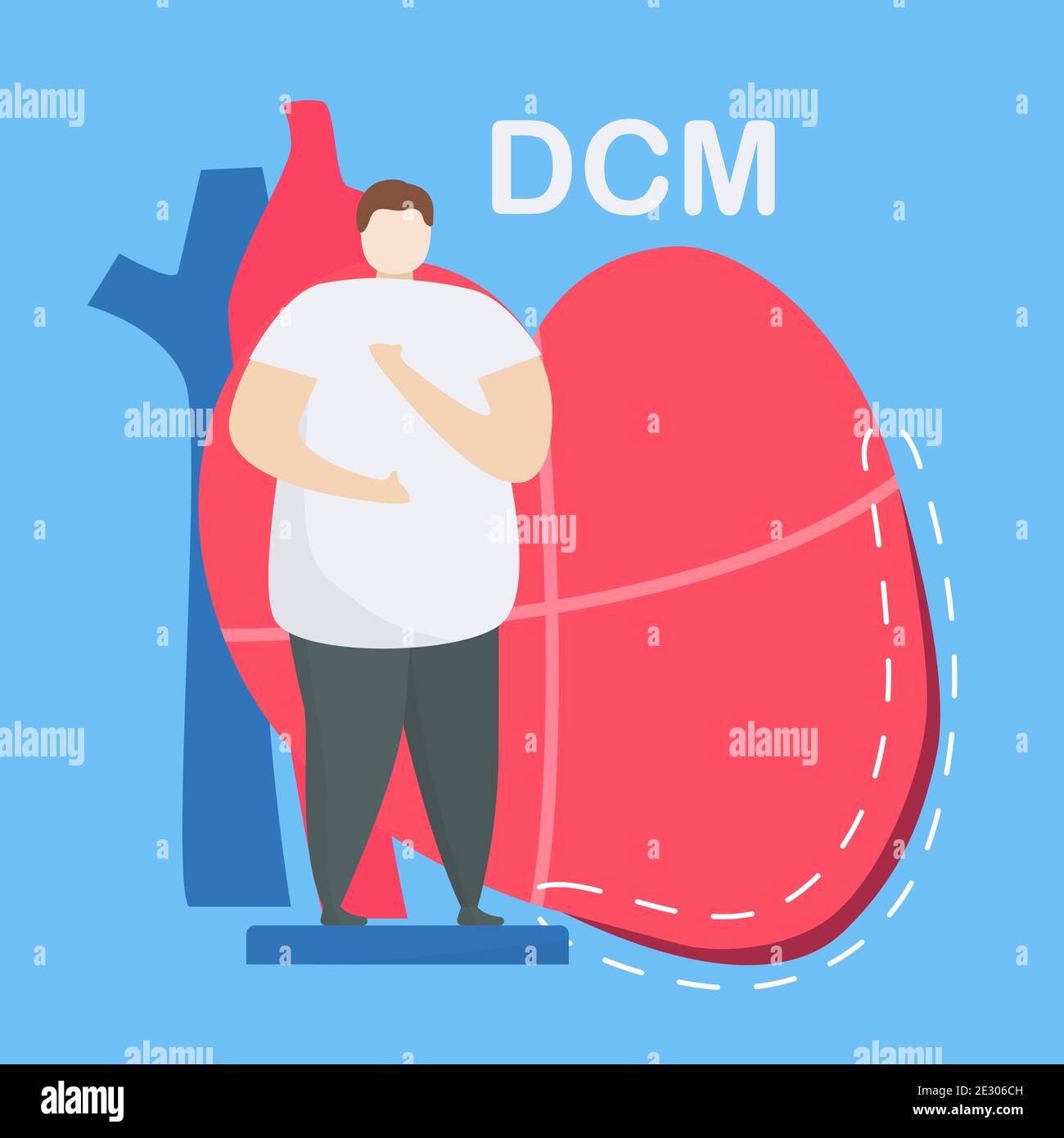 Illustrazione del vettore cardiologico. Questa malattia chiama cardiomiopatia dilatata. La capacità di pompaggio del sangue è ridotta. La sala del ventricolo sinistro del cuore è enla Illustrazione Vettoriale