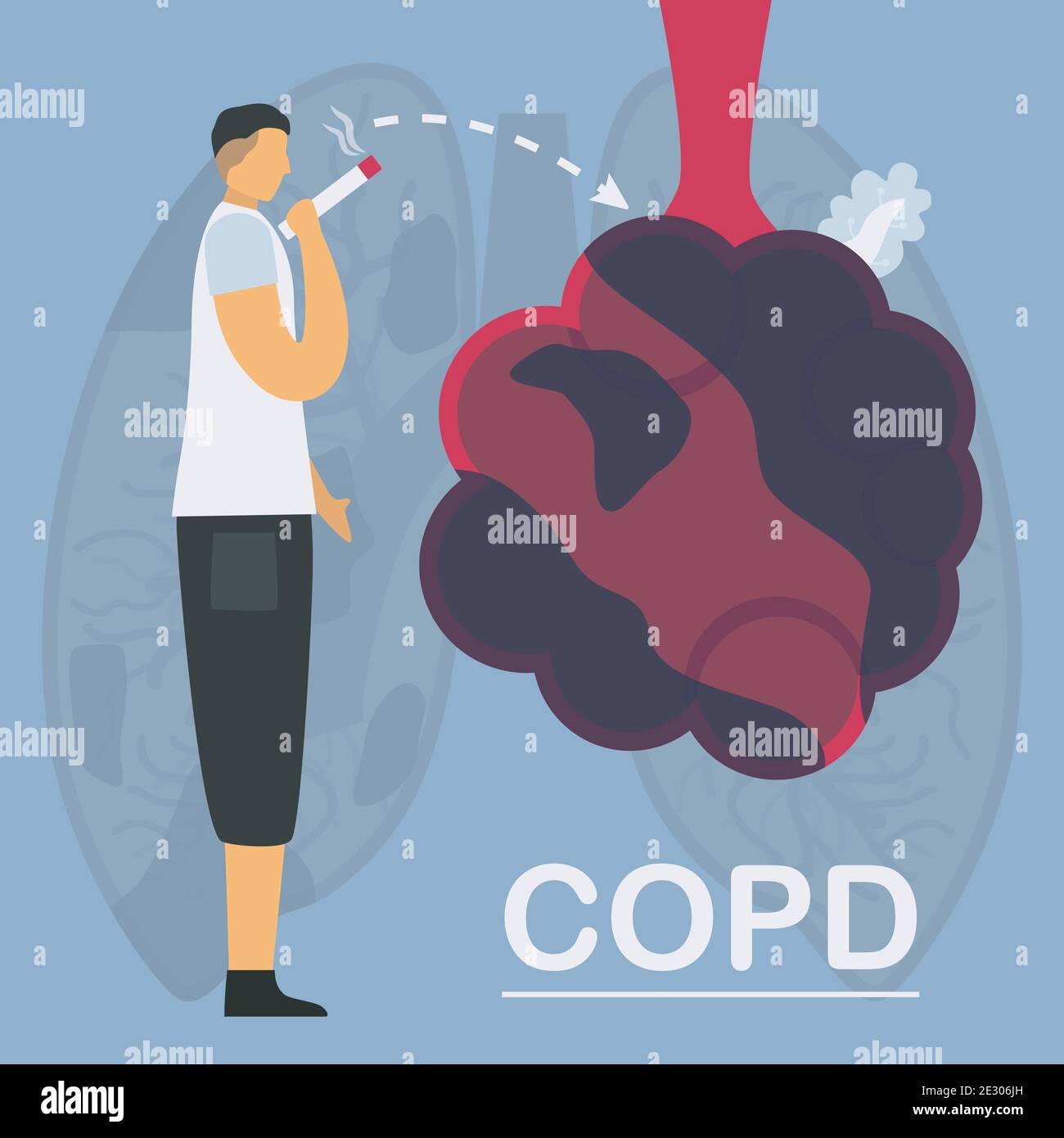 Il fumo è causa di broncopneumopatia cronica ostruttiva o BPCO. I polmoni hanno problemi respiratori e un flusso d'aria insufficiente. Illustrazione vettoriale in design piatto. Illustrazione Vettoriale
