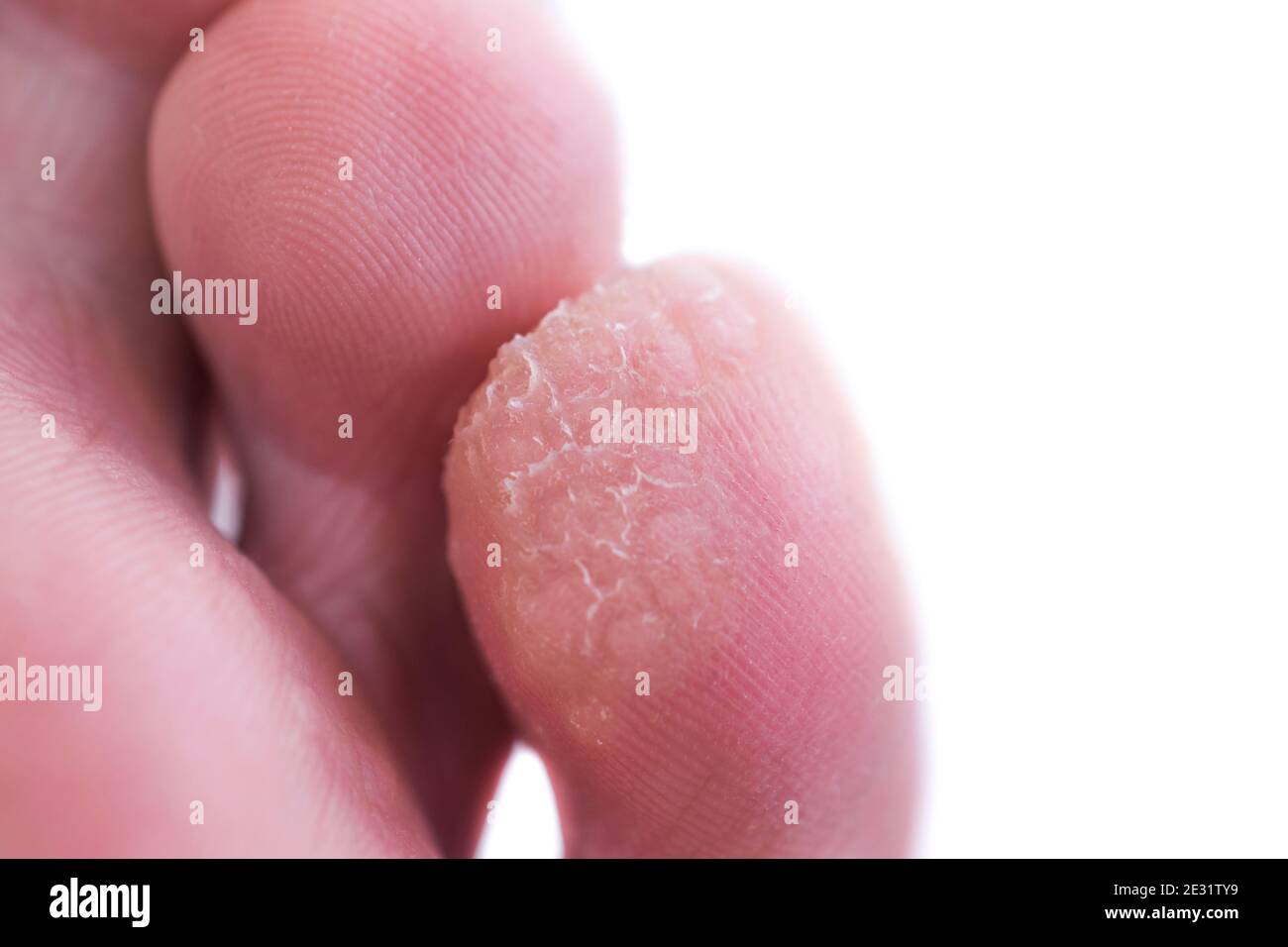 Un caso di verruca o verruche plantari sul fondo del piede piccolo. Una foto ravvicinata di una verruca. Le verruche richiedono un trattamento. Foto Stock