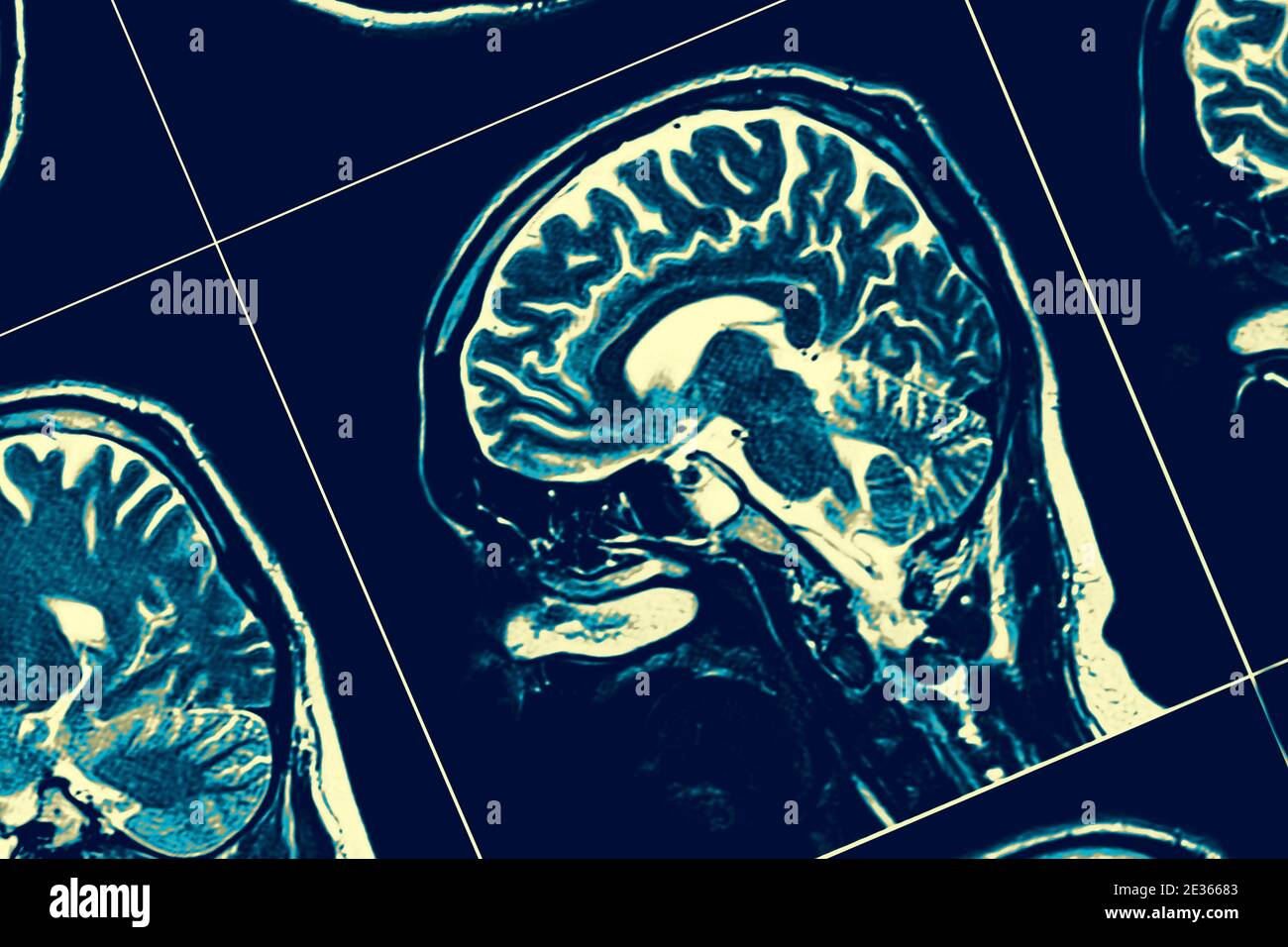 Sezione sagittale del cervello. Foto Stock
