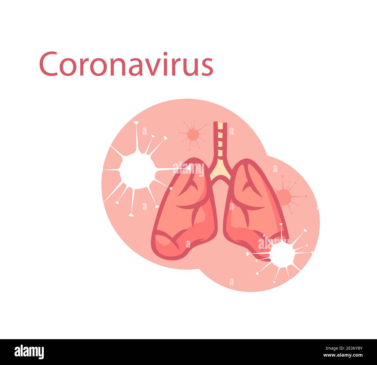 Coronovirus infettando la clepart polmonare. I virus respiratori danneggiano l'organo polmonare e causano polmonite da distruzione tissutale. Illustrazione Vettoriale
