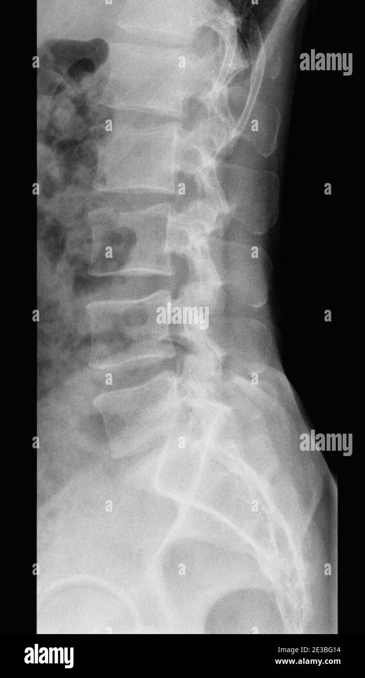foto a raggi x della colonna lombare umana - uomo adulto, vista laterale Foto Stock