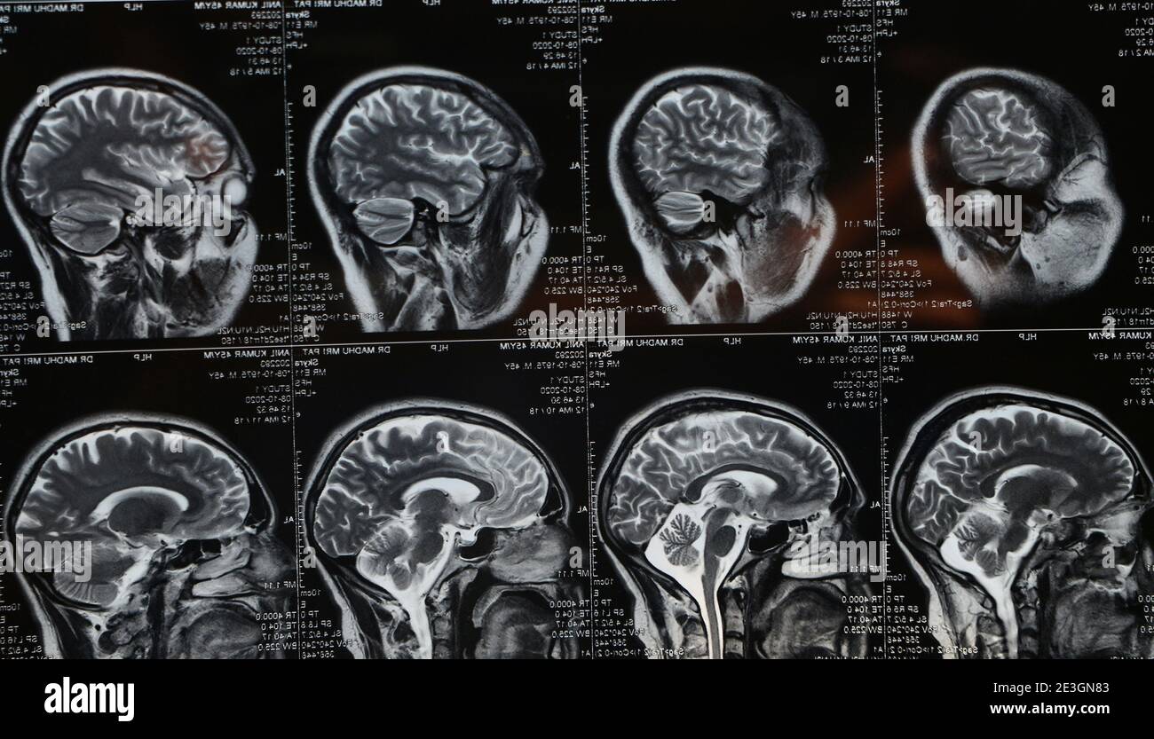 MRI Brain Scan of Head and Skull (scansione cerebrale RM di testa e cranio Foto Stock