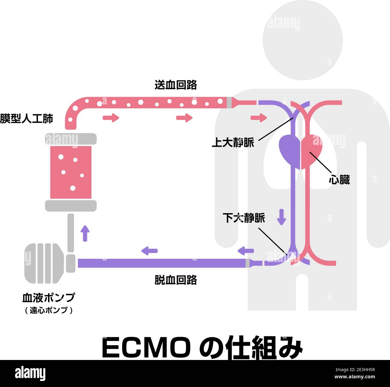 ECMO ( ossigenazione extracorporea della membrana ) Illustrazione vettoriale della struttura / Giapponese Illustrazione Vettoriale