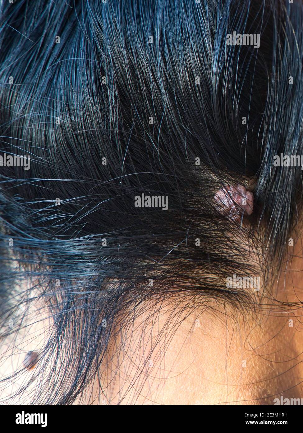 Etichetta della pelle, Acrochordon sulla testa femminile. Foto Stock