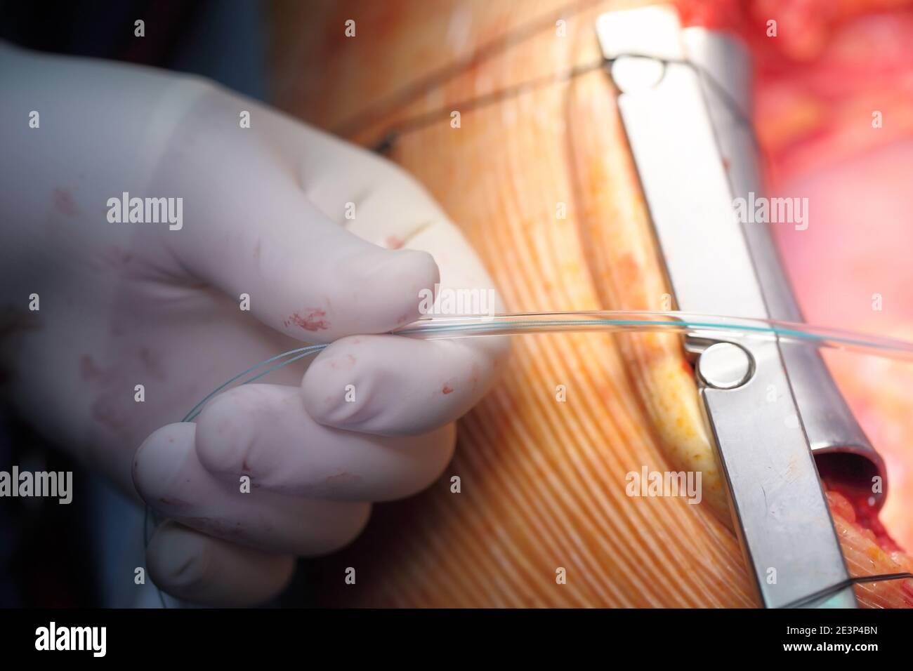 La mano del chirurgo, che esegue la manipolazione nella ferita operatrice. Foto Stock