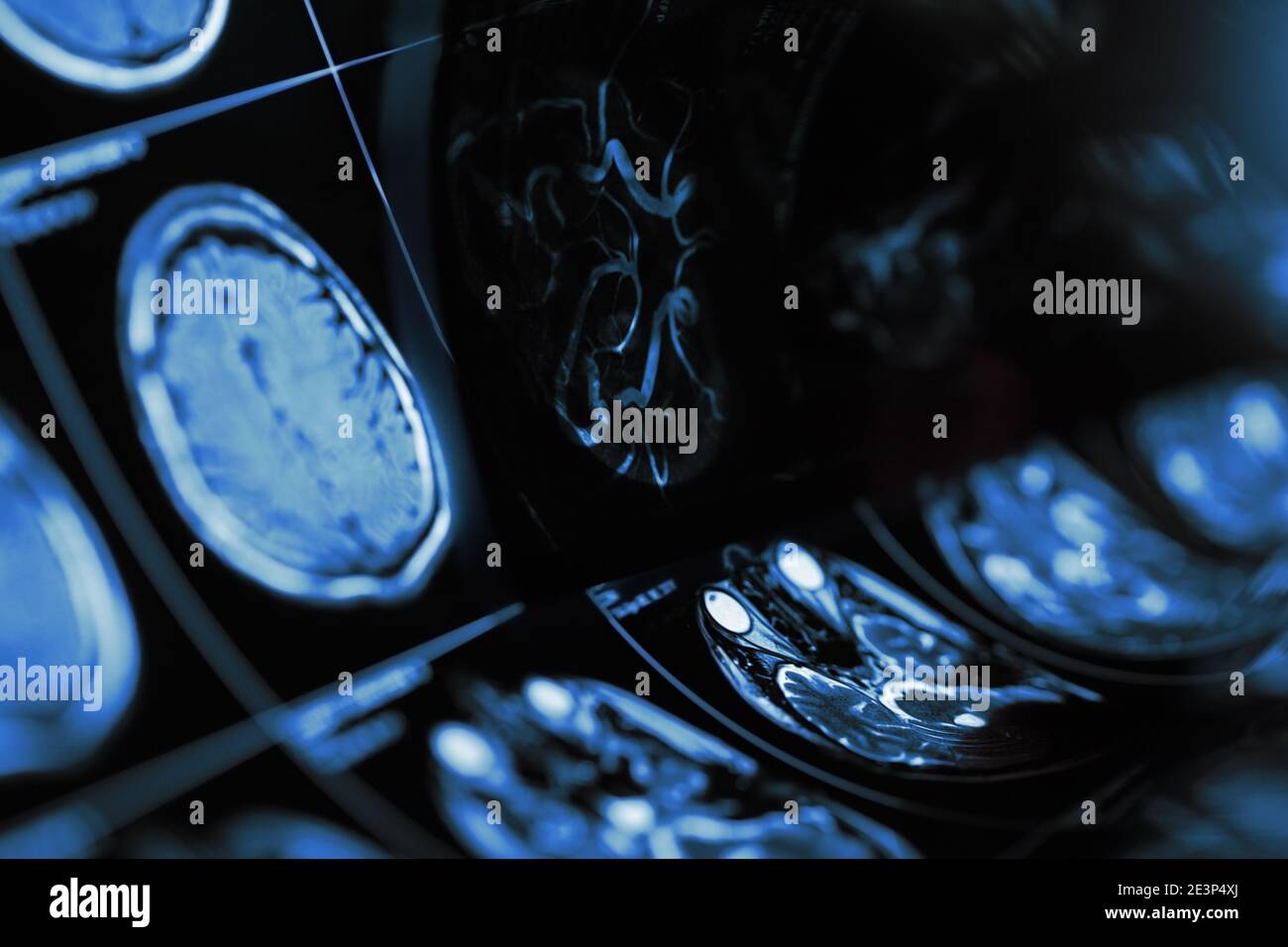 Imaging di risonanza magnetica del cervello umano con sospetta cerebropatia. Foto Stock