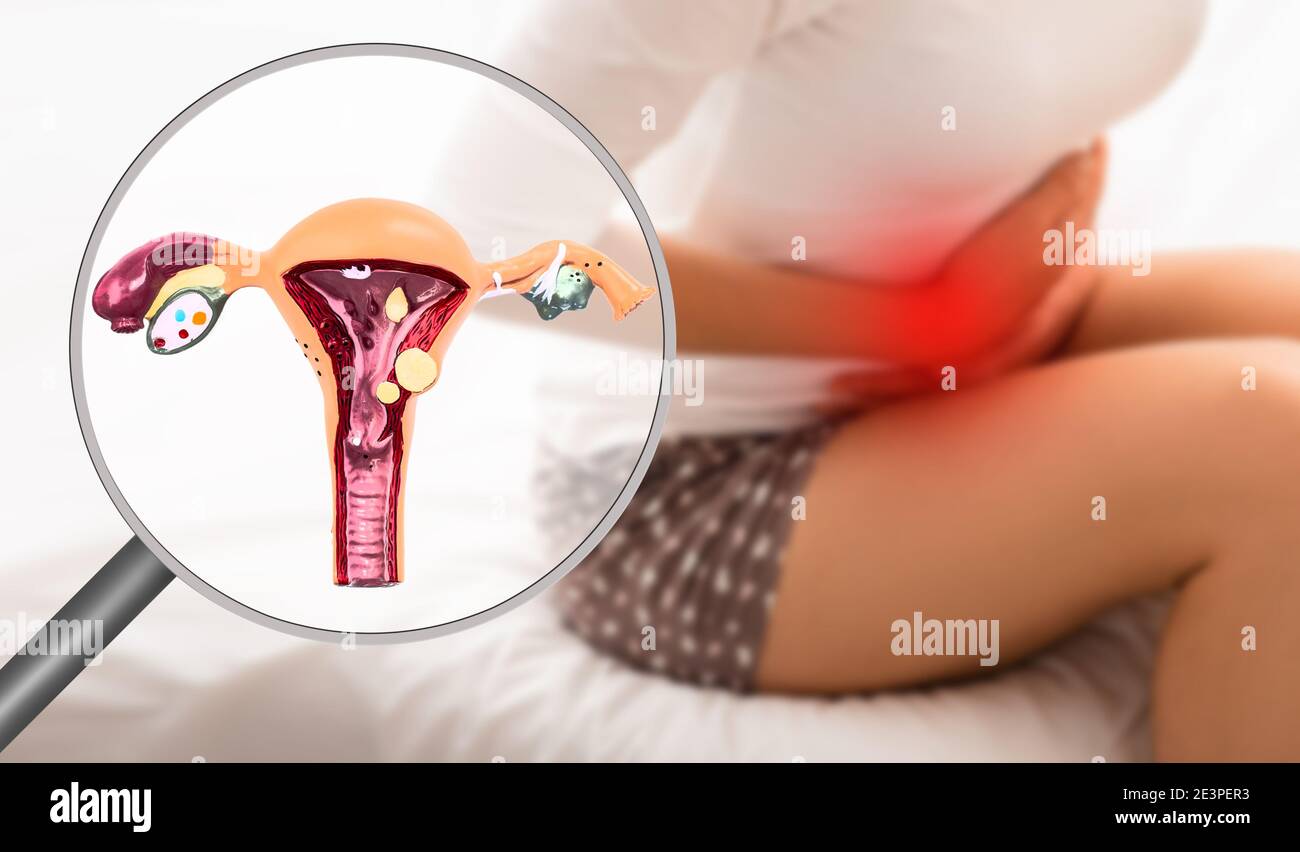 Endometriosi, modello virtuale dell'utero, primo piano. Donna che soffre di dolore mestruale, mentre si siede a letto. Dolore allo stomaco Foto Stock