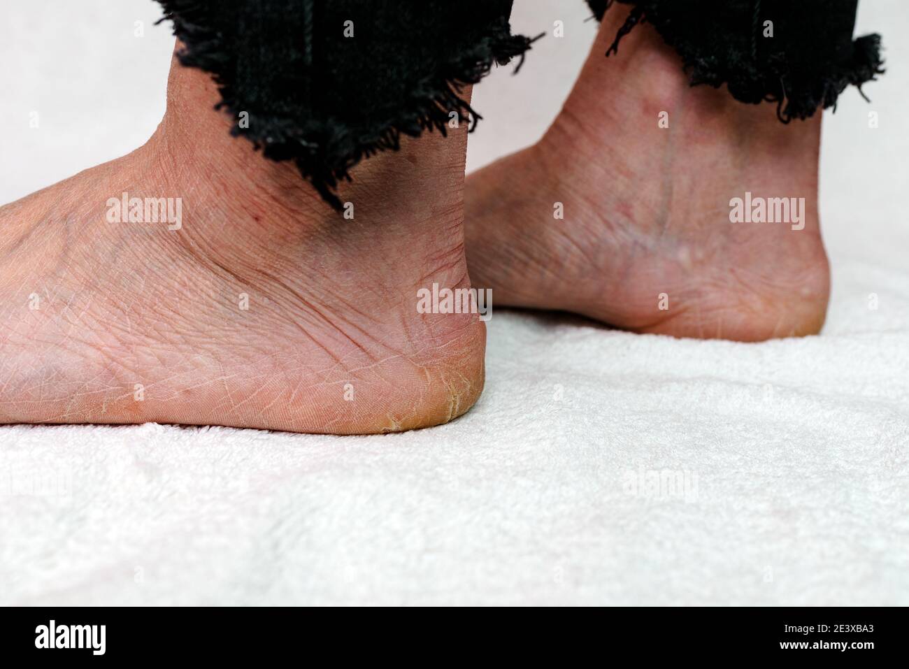 Suole di piedi asciutte e fessurate. Piedi Womans con tacchi asciutti, cracked skin.White sfondo morbido. Foto Stock