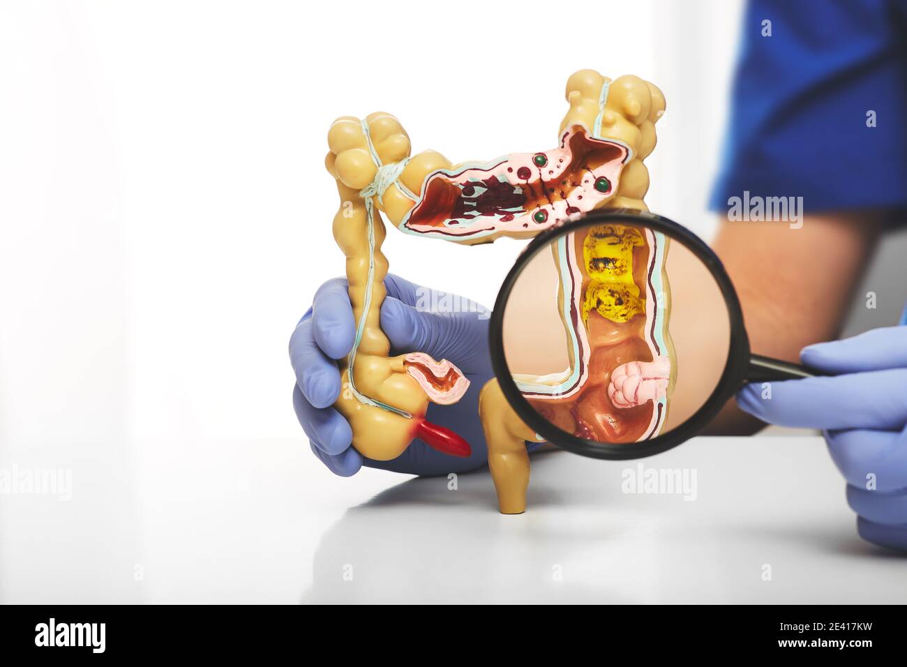 Modello del colon con le malattie differenti nelle mani dei medici. Tumore del colon ingrandito in una lente di ingrandimento Foto Stock