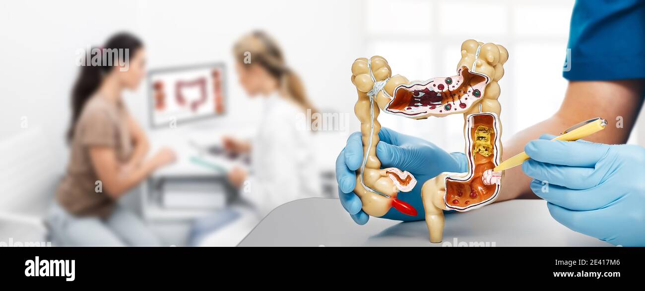 Trattamento cancro colon. medico che indica l'intestino del tumore a penna utilizzando un modello anatomico. Consultare il gastroenterologo per un paziente in background Foto Stock