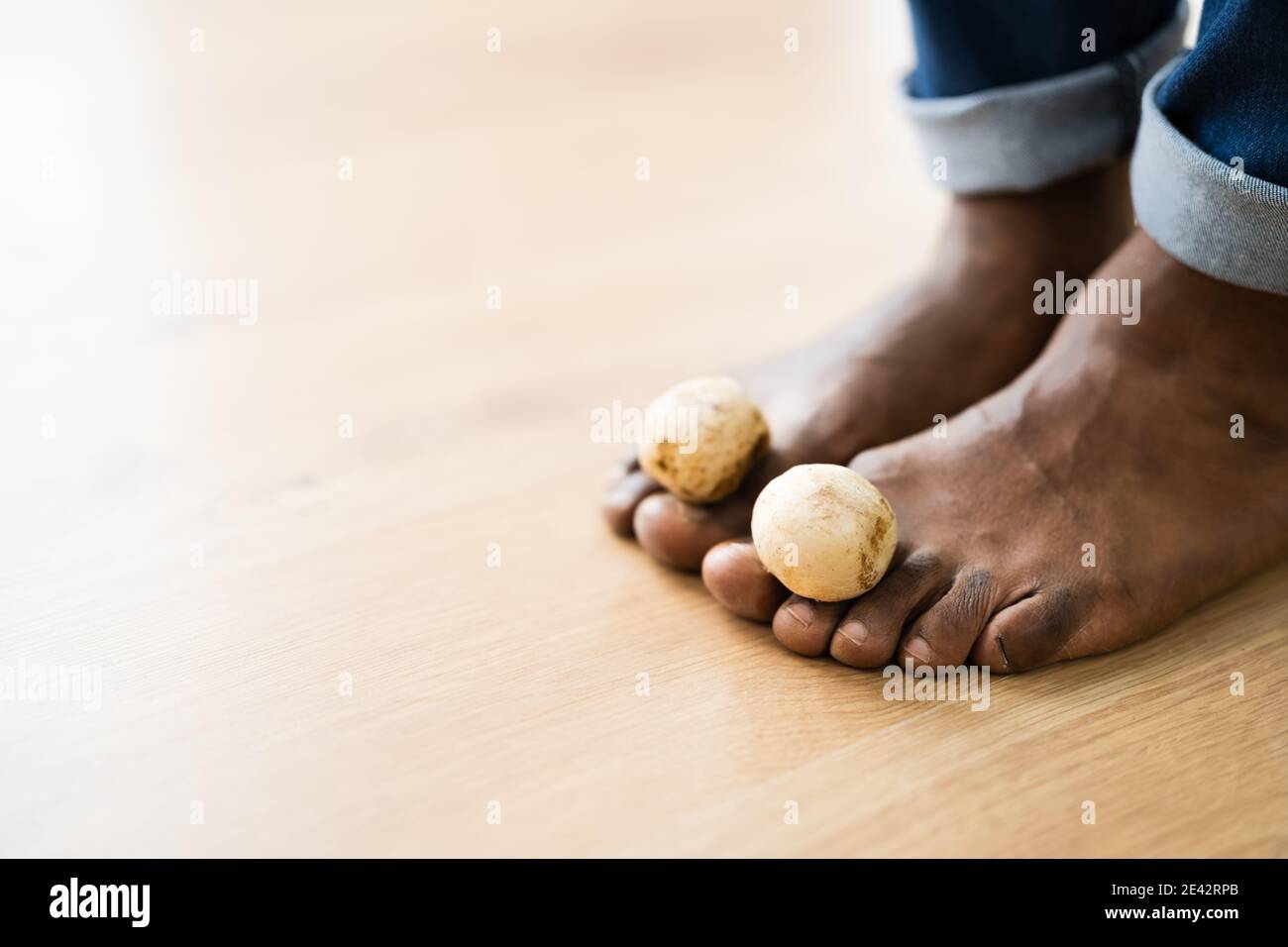 Piedi funghi fungo tra Toenail. Funghi del piede Foto Stock