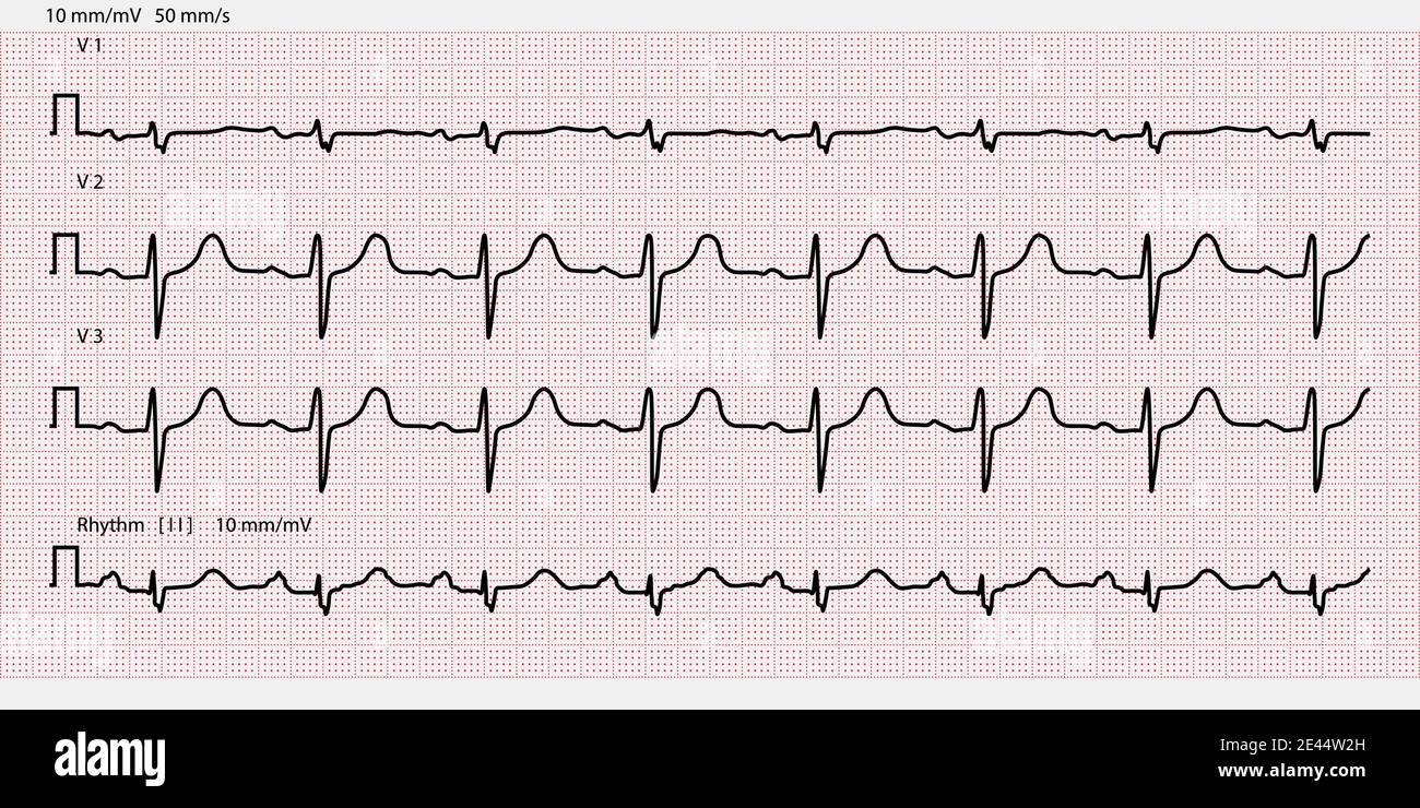 Carta per elettrocardiogramma, carta millimetrica. Illustrazione vettoriale Illustrazione Vettoriale
